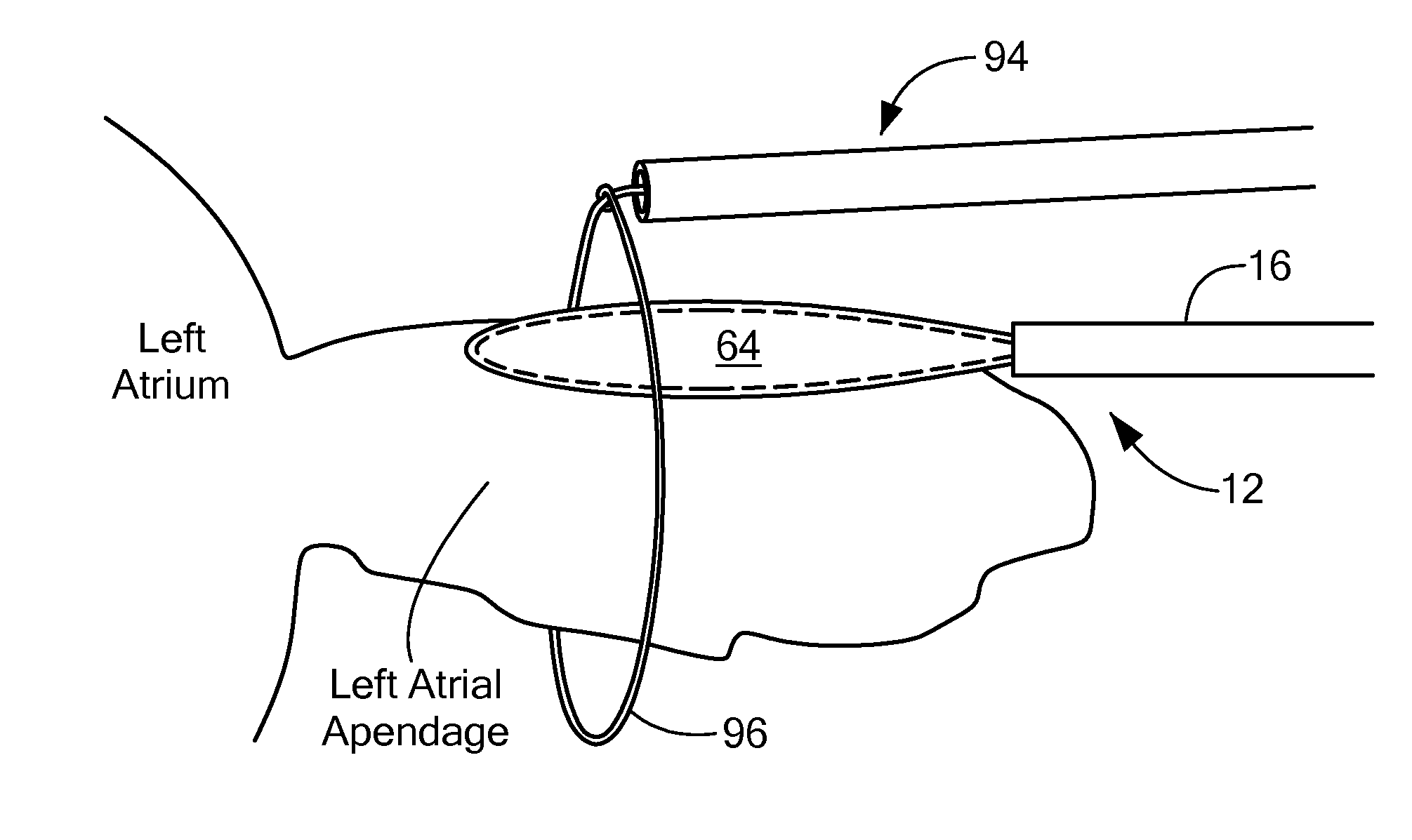 Cryoadhesive device for left atrial appendage occlusion