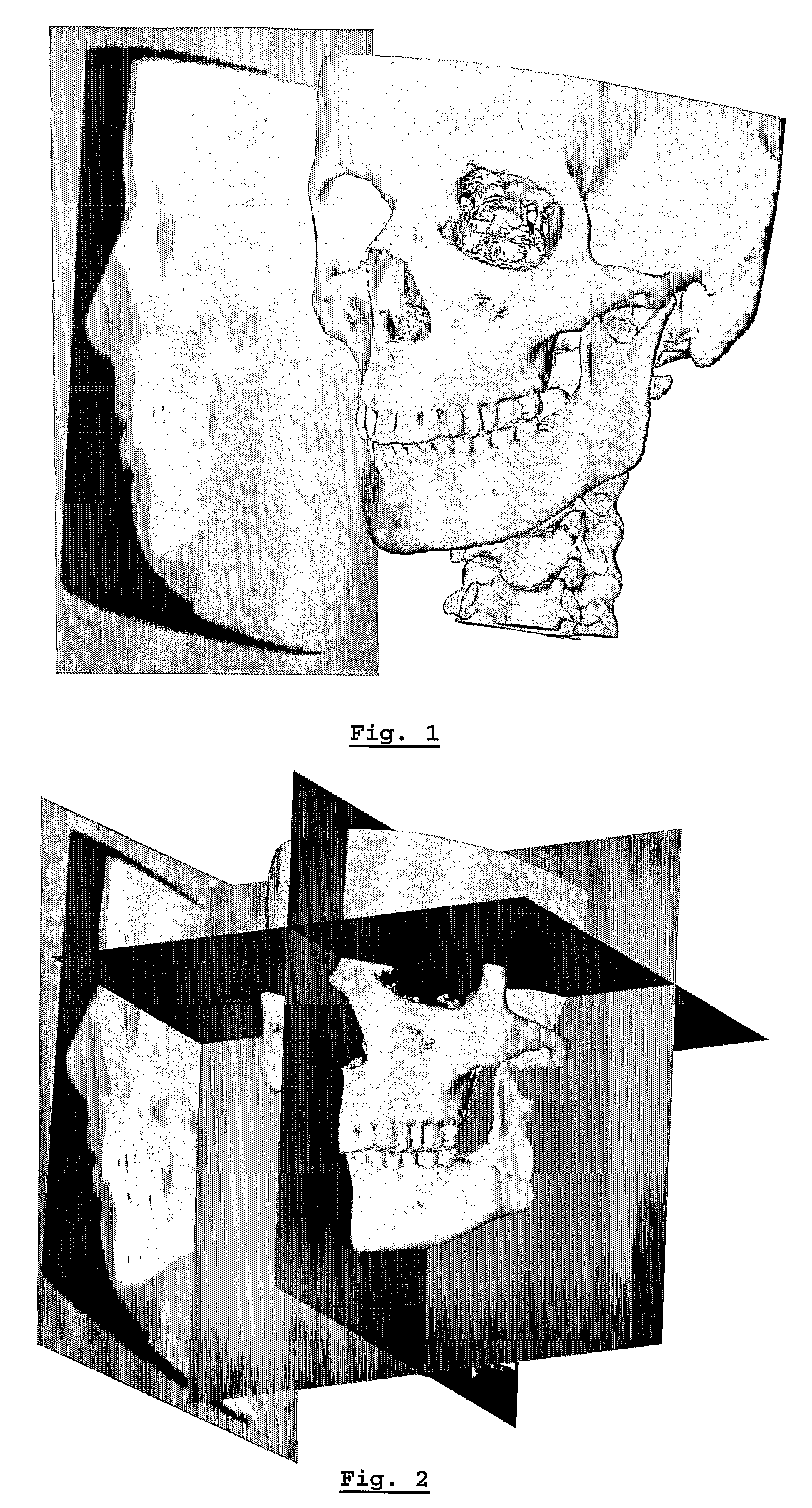 Method for deriving a treatment plan for orthognatic surgery and devices therefor