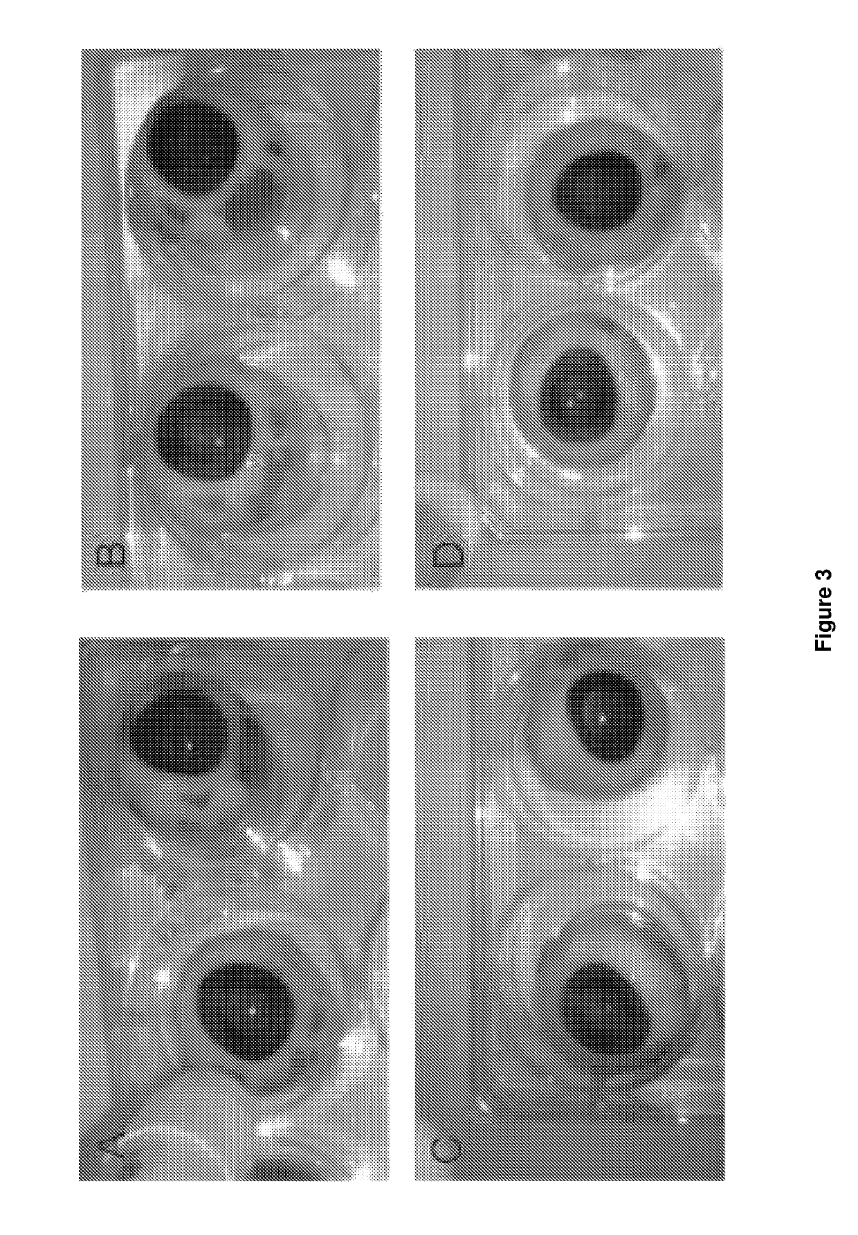 Composition comprising diacid derivatives and their use in the treatment of collagenic eye disorders