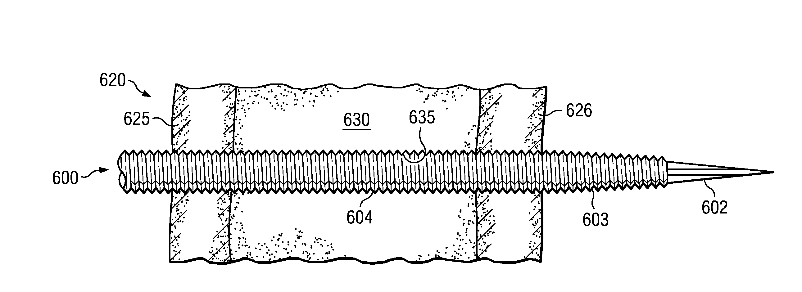 Tapered threaded orthopedic fastener engaging predetermined radial preloads