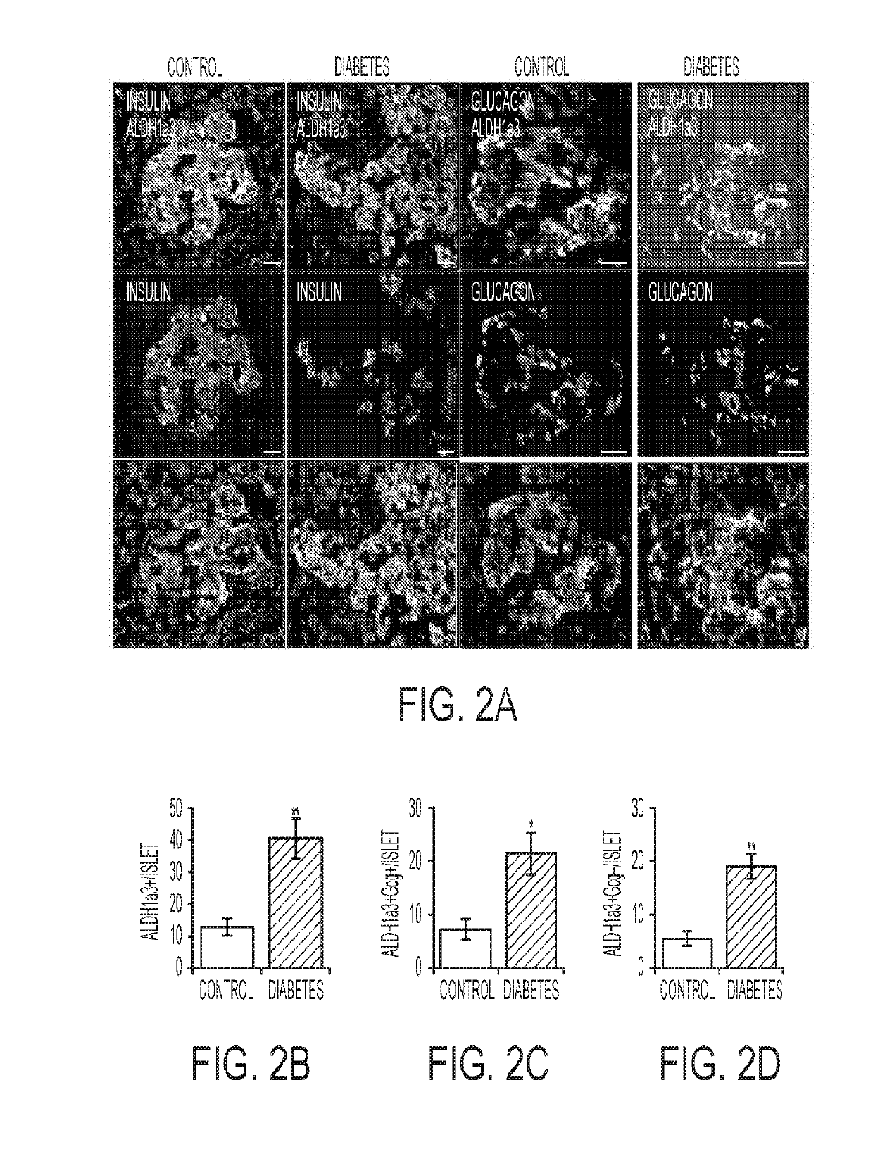 Use of aldehyde dehydrogenase as biomarker for beta-cell dysfunction and loss