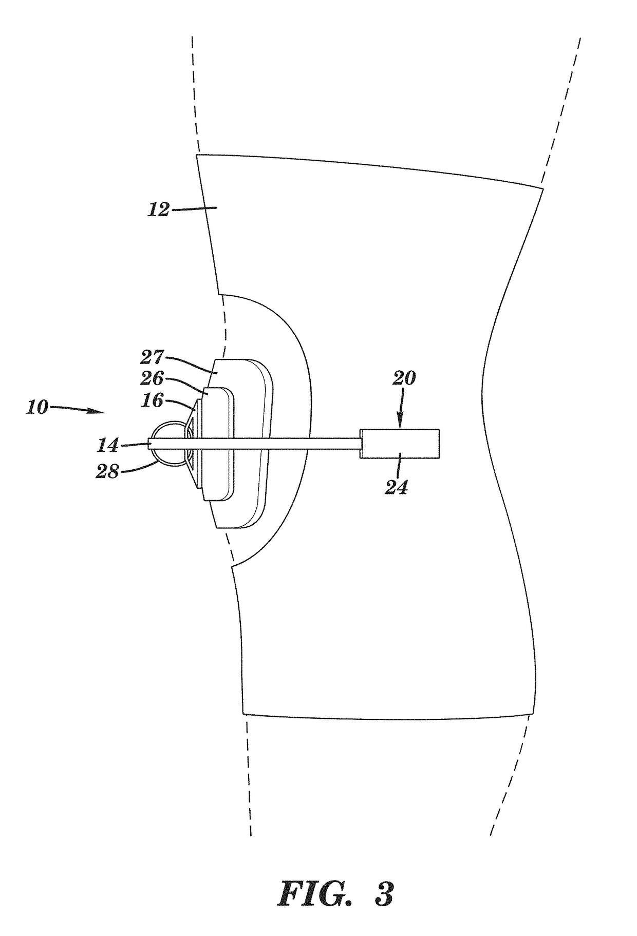 Device for managing patellofemoral pain and methods of use thereof