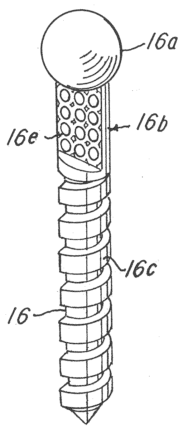 Implant and a system and method for processing, desiging and manufacturing an improved orthopedic implant