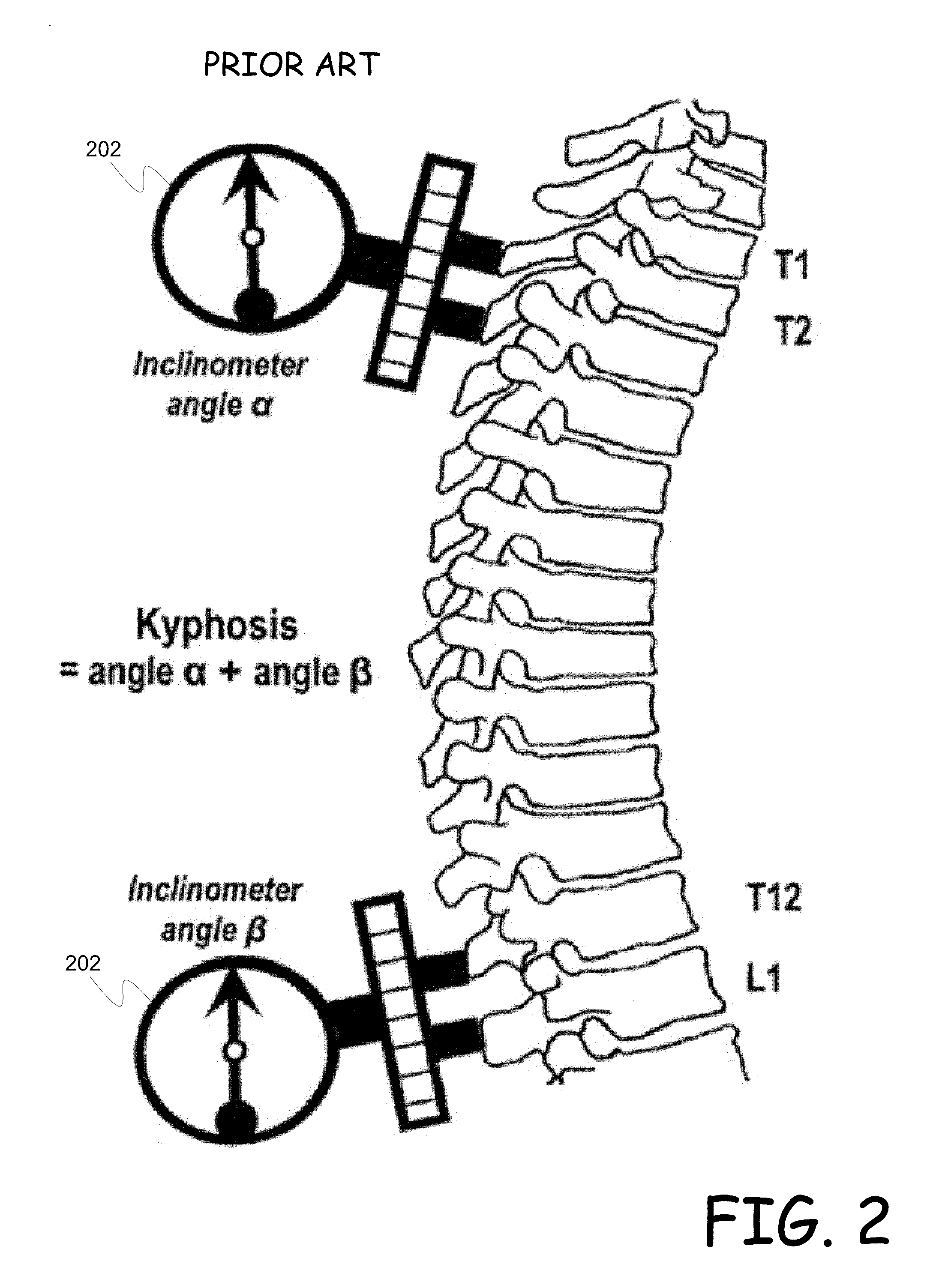 Mobile kyphosis angle measurement