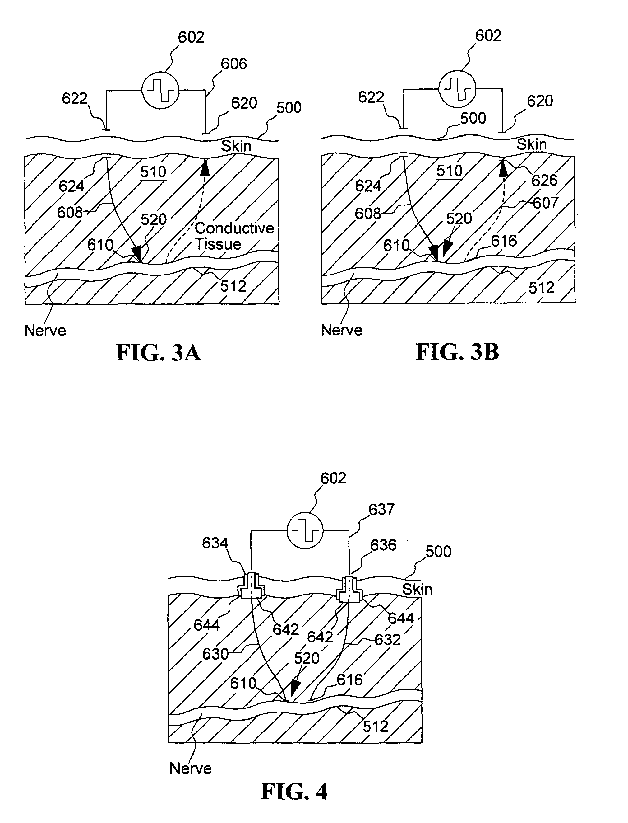 Neural stimulator with percutaneous connectivity