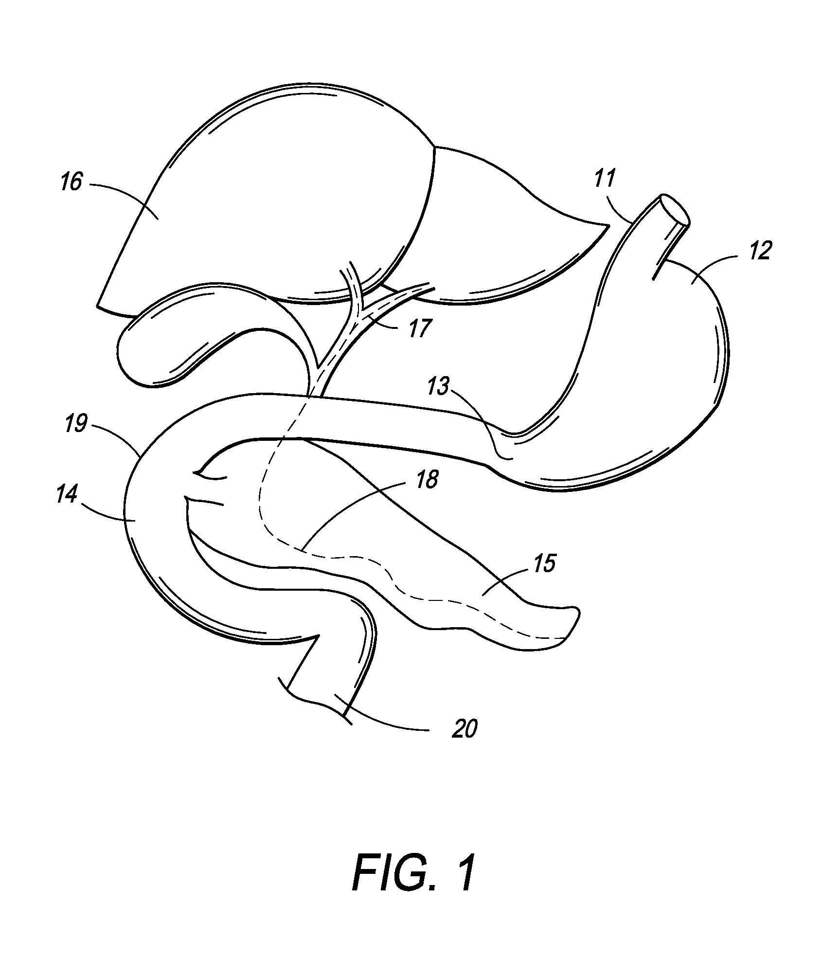 Intragastric Device for Treating Obesity