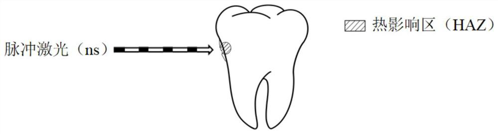 A supragingival scaling device based on high repetition rate femtosecond pulsed laser