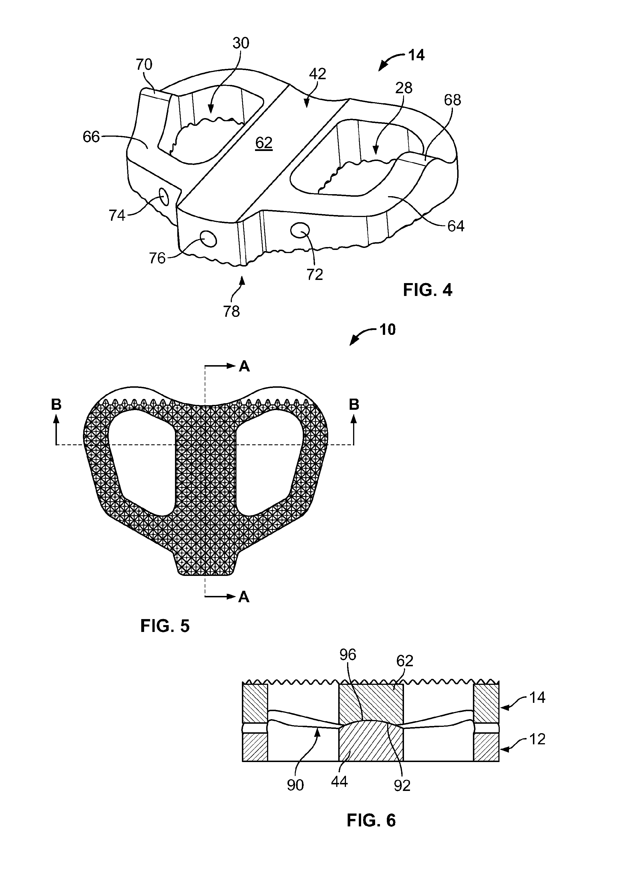 Spinal Implant, Instrument for Preparation and Method of Use