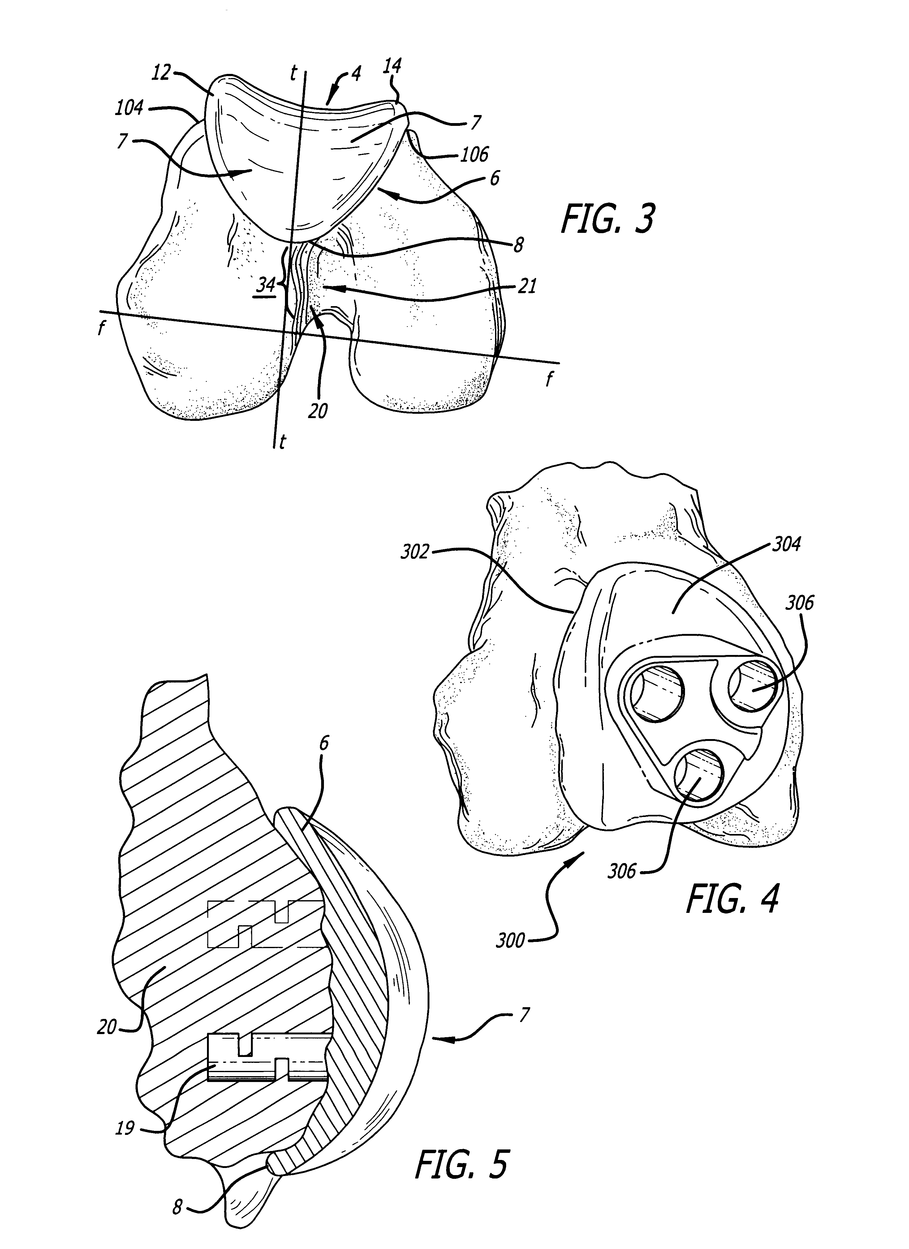 Custom replacement device for resurfacing a femur and method of making the same