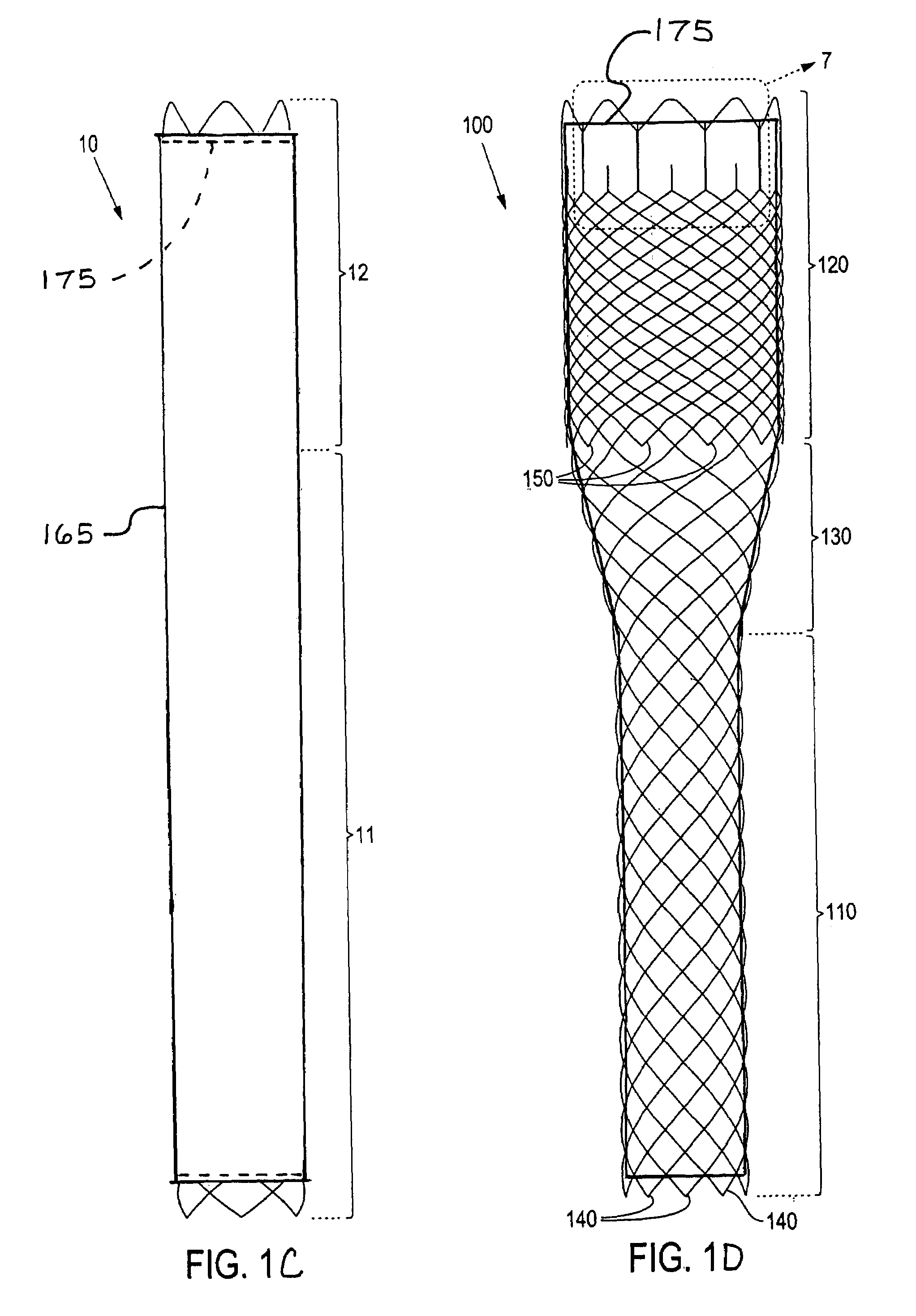 Braided stent method for its manufacture