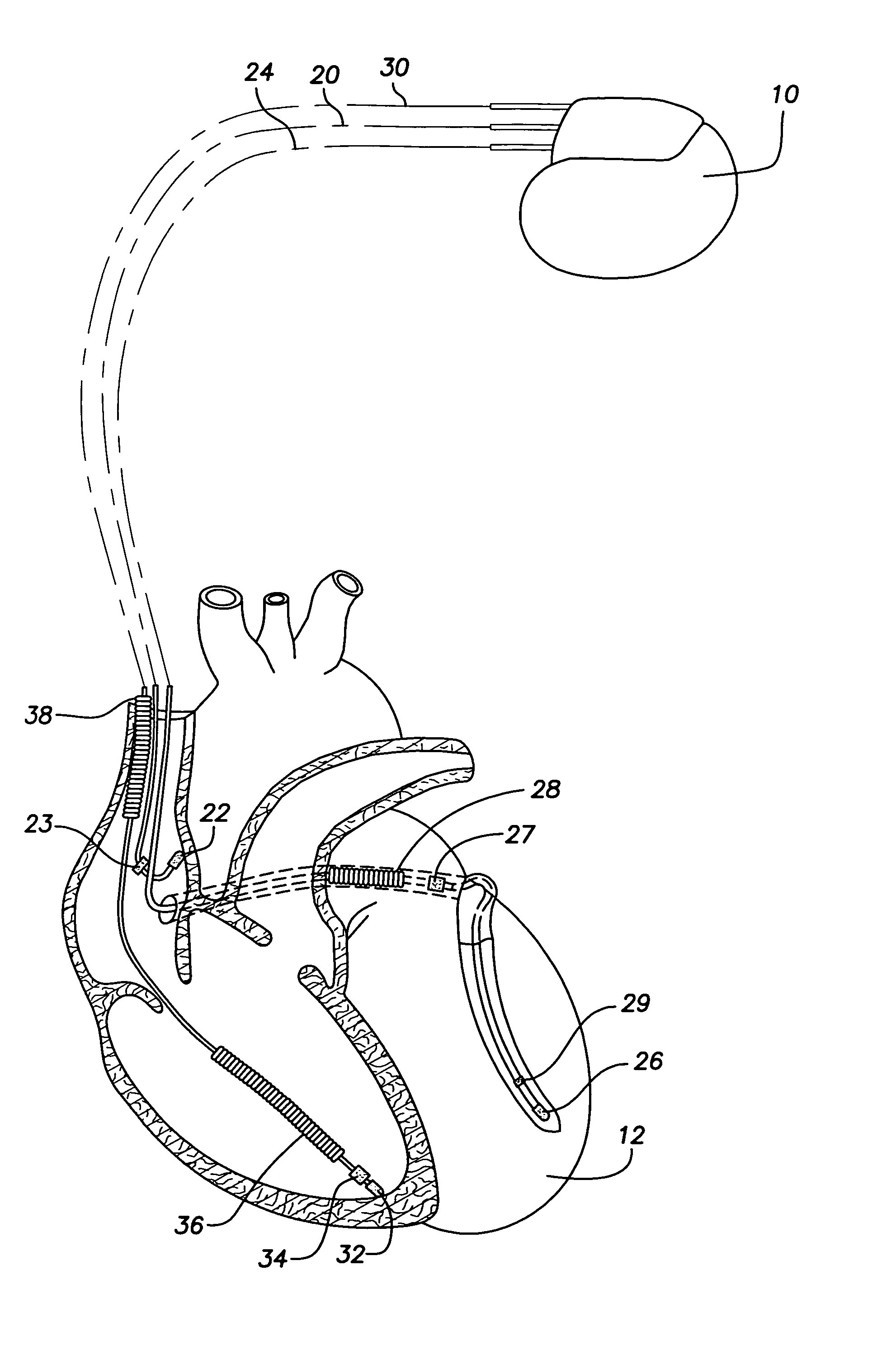 System and method for emulating a surface EKG for use with transtelephonic monitoring of an implantable medical device