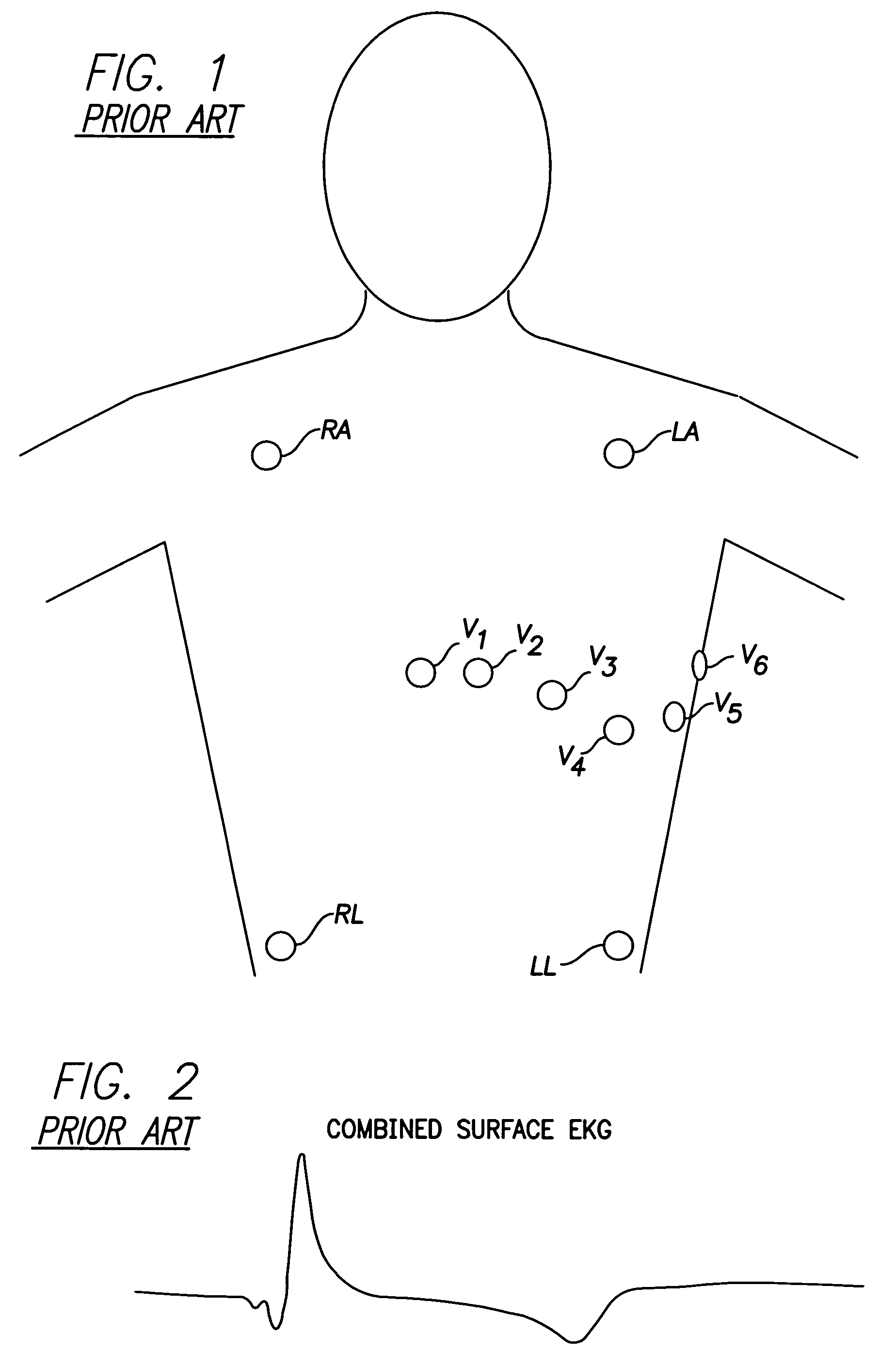 System and method for emulating a surface EKG for use with transtelephonic monitoring of an implantable medical device