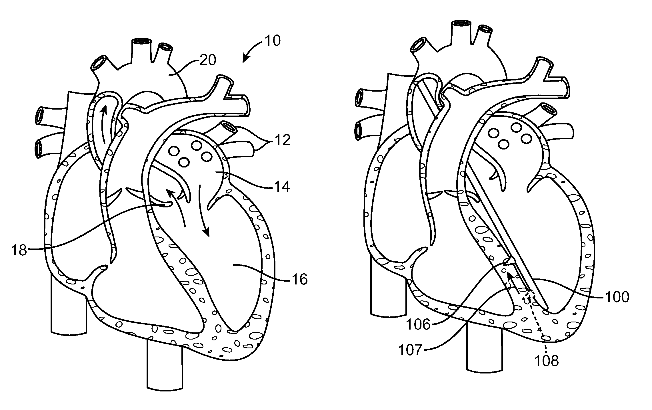 Methods and devices for diastolic assist