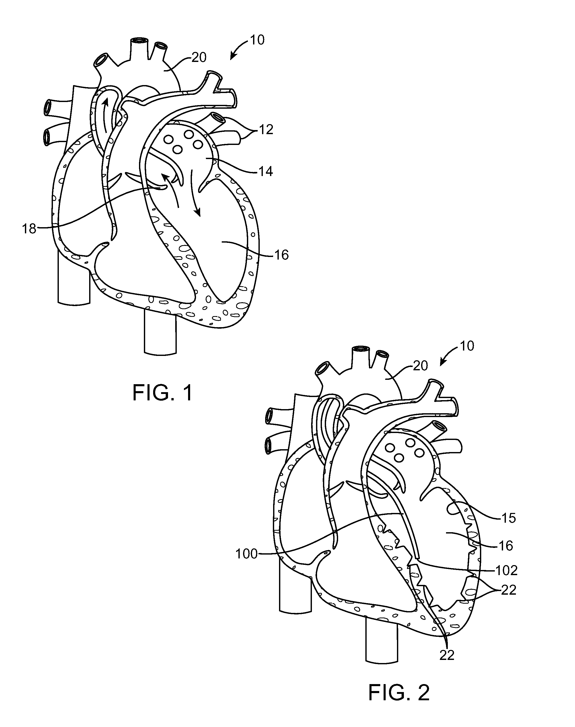 Methods and devices for diastolic assist