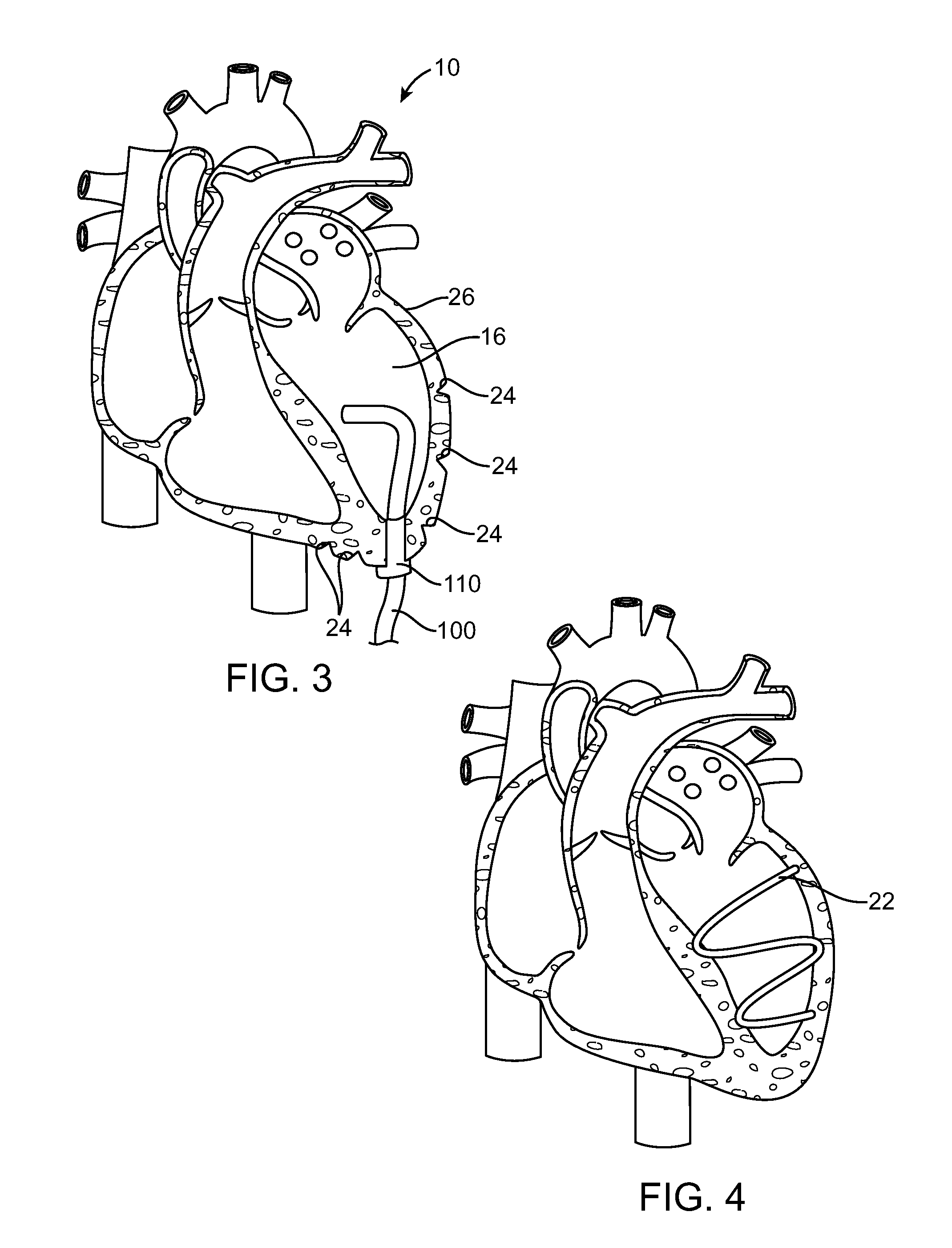 Methods and devices for diastolic assist