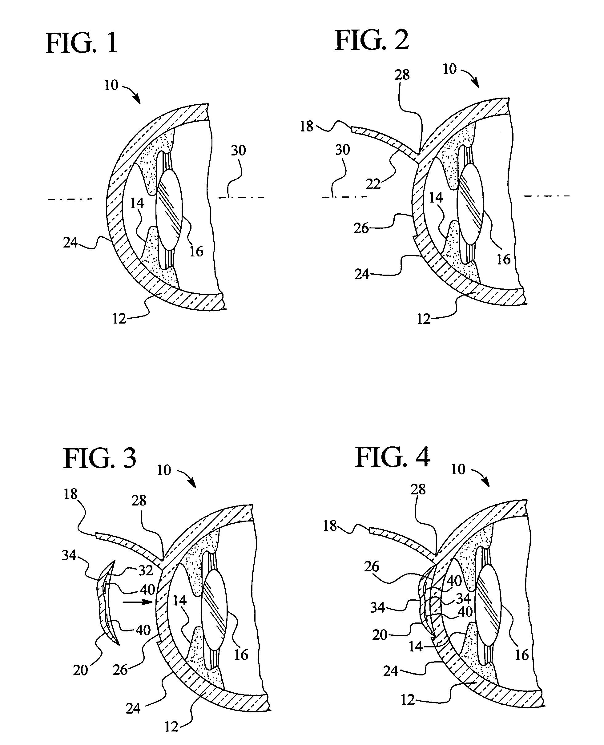 Method of reshaping the cornea by controlled thermal delivery