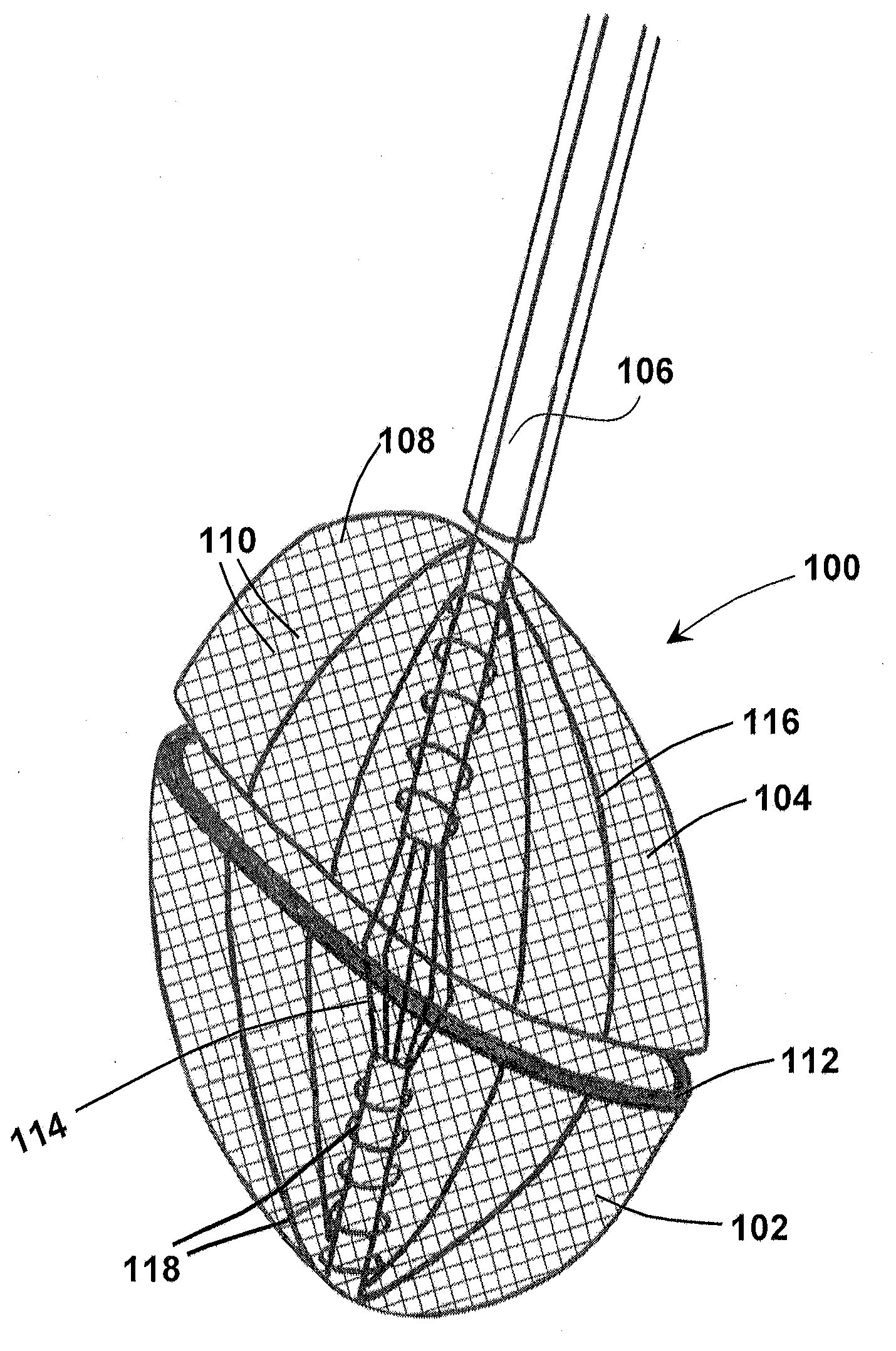 Methods for removing a valve from a vessel