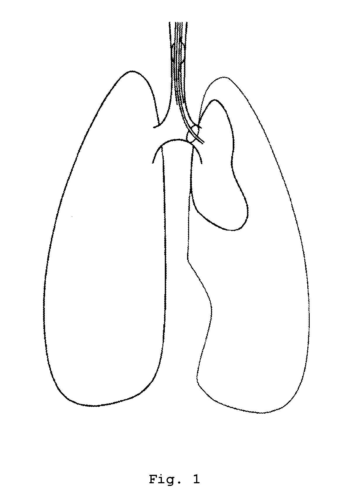 Double lumen tube capable of fixing trachea carina