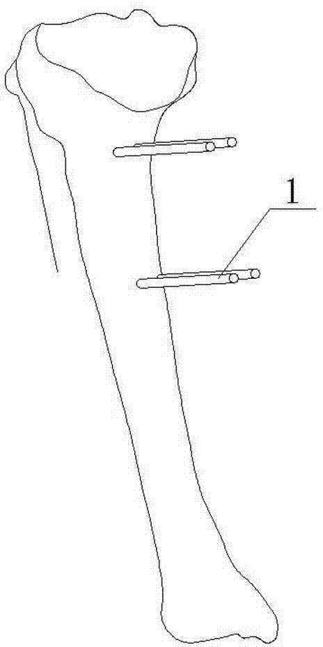 Combined osteotomy guide