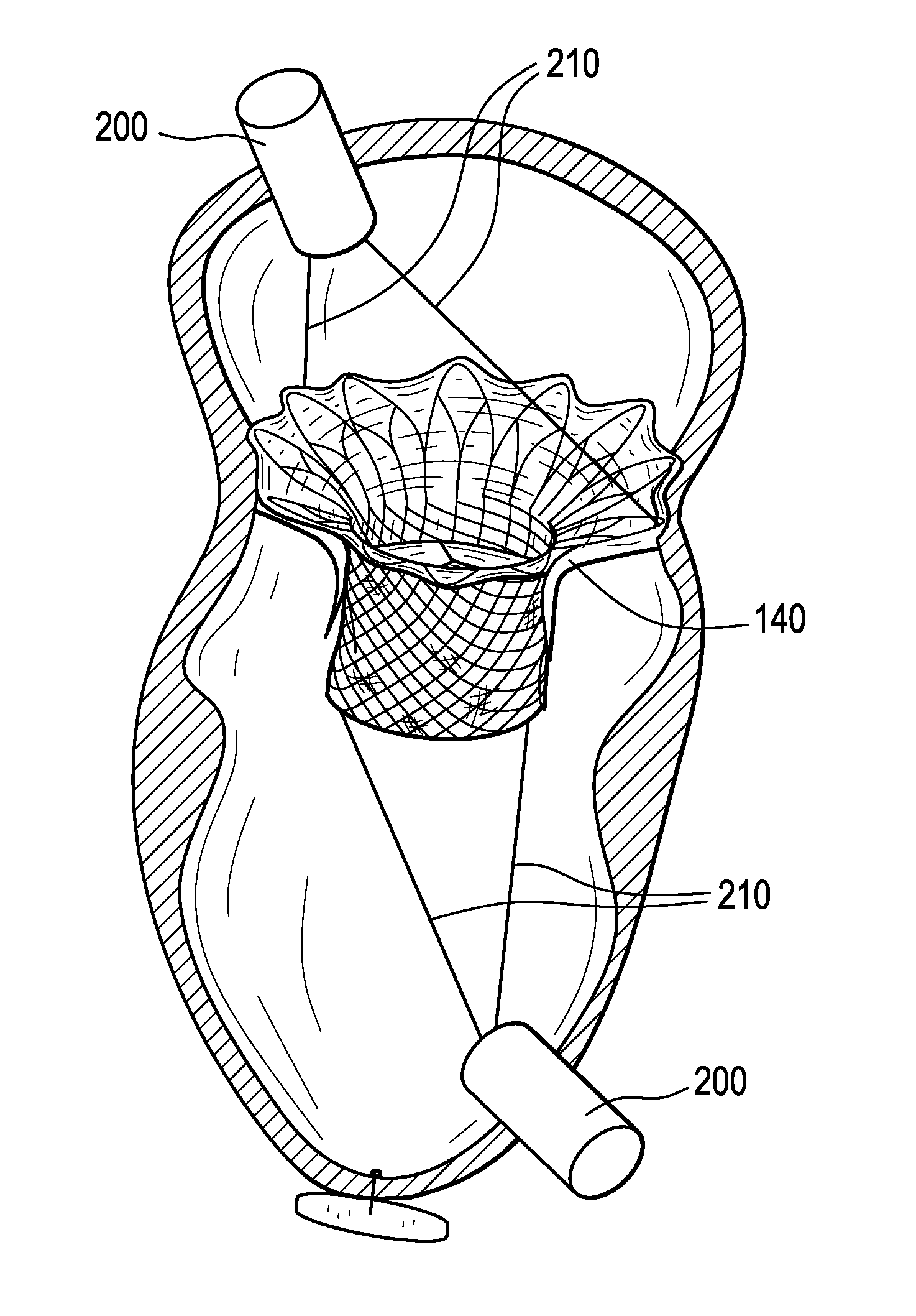 Tethers for Prosthetic Mitral Valve