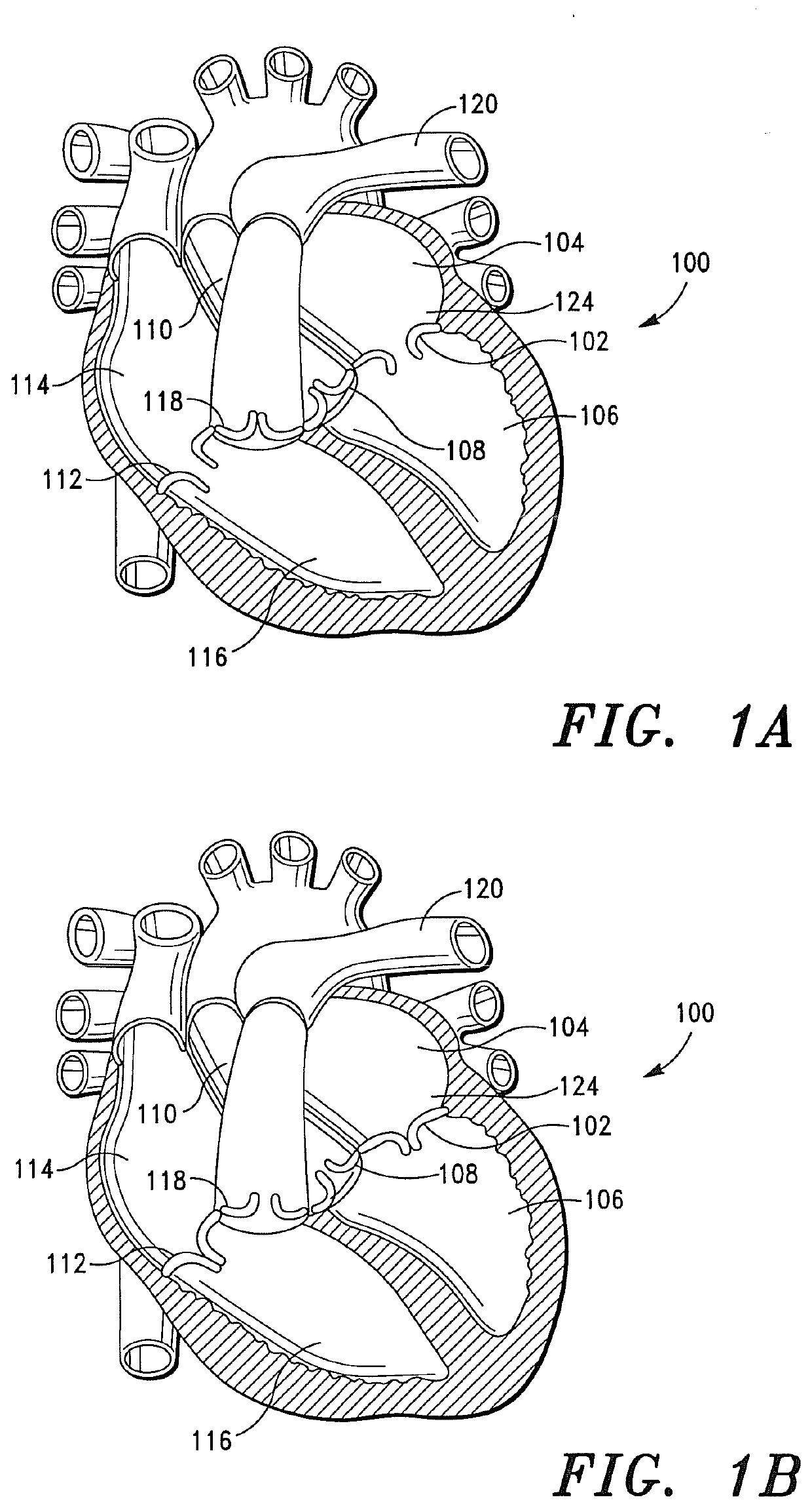 Prosthetic Cardiovascular Valves and Methods for Replacing Native Atrioventricular Valves with Same