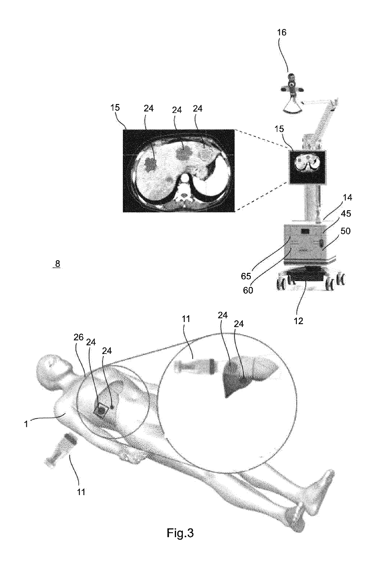 System and method for the determination of a dose in radiotherapy