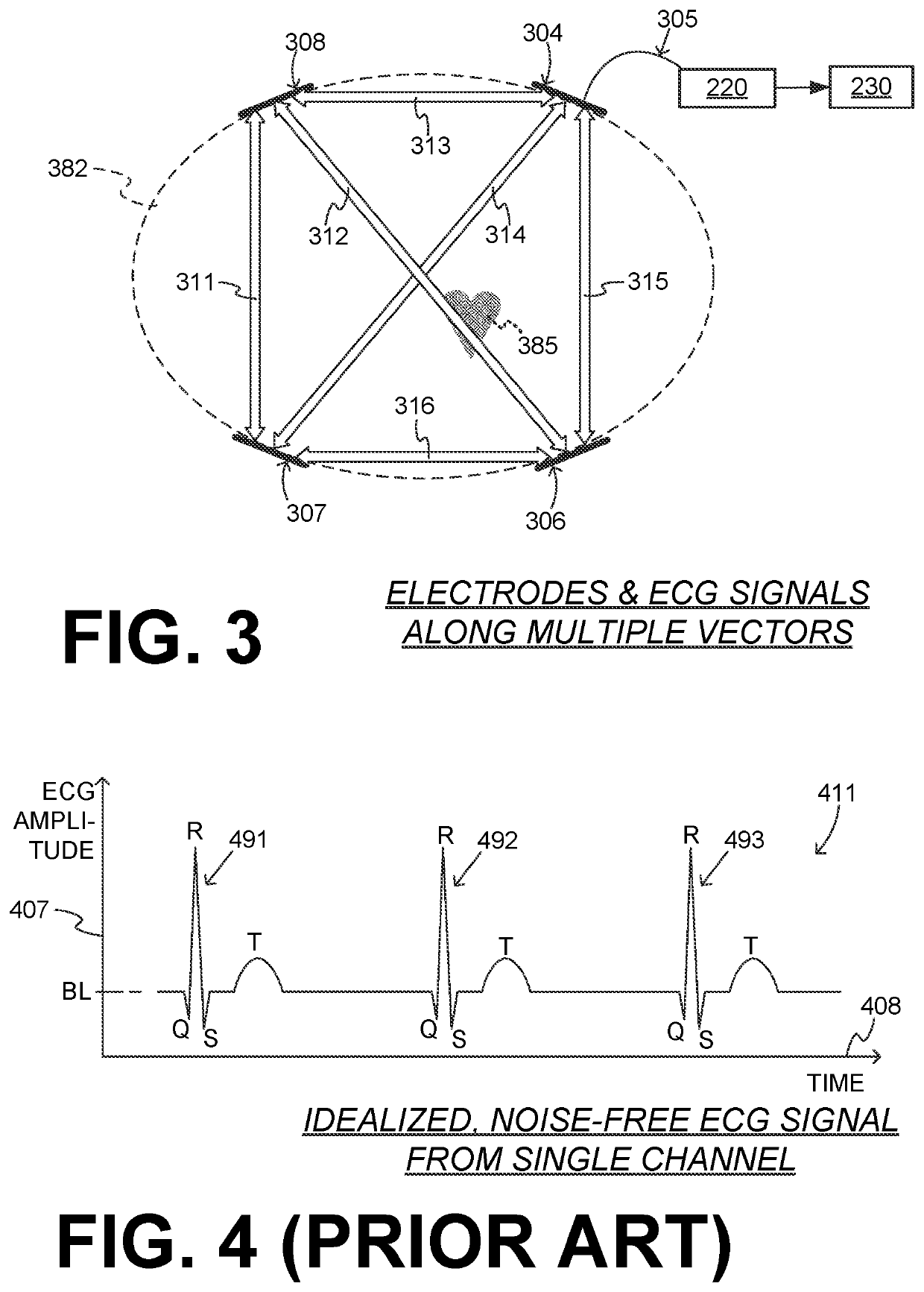 Medical device with enhanced electrocardiogram channel selection