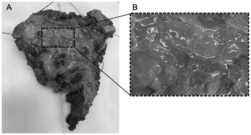 Human-derived chordoma bone in-situ PDX model construction method and application thereof