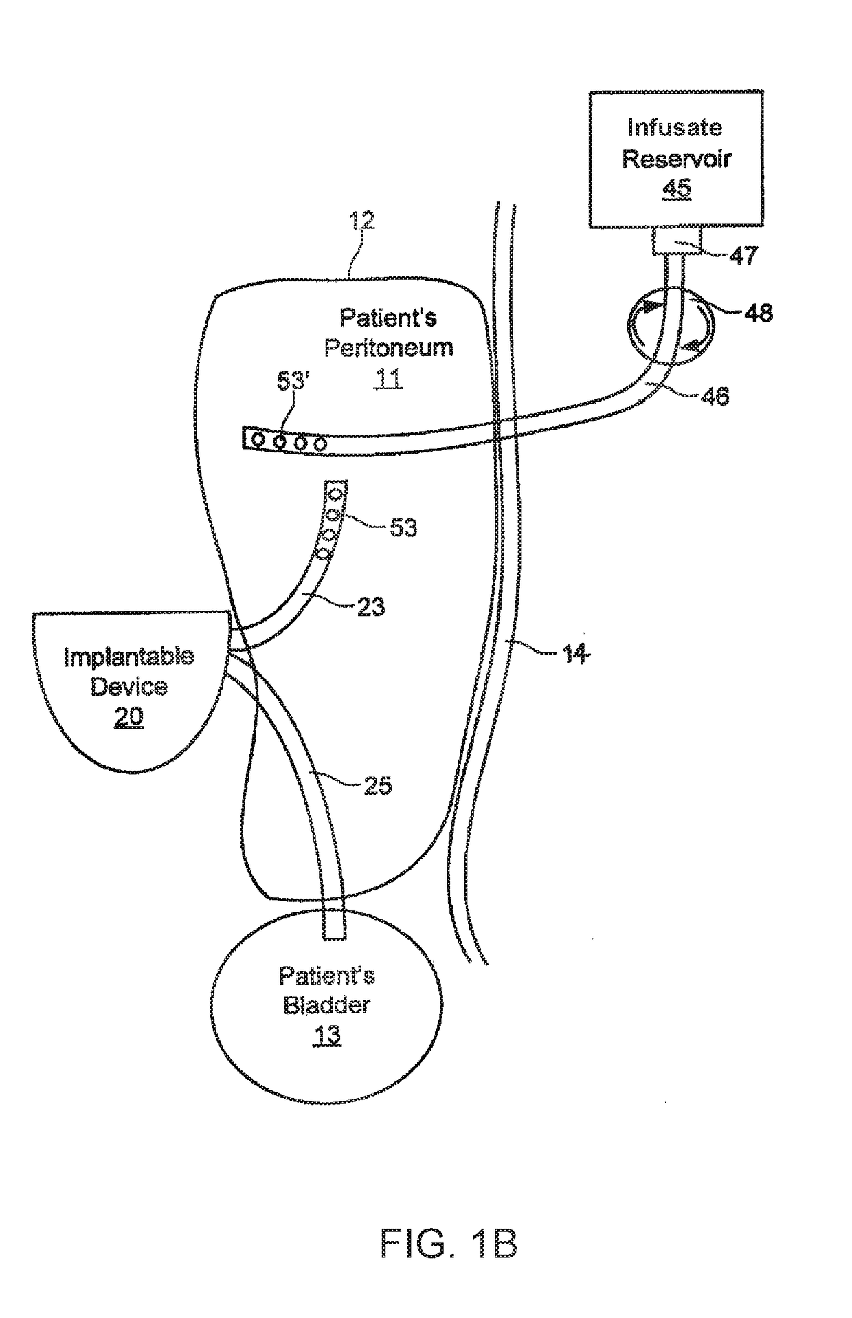 Direct sodium removal method, solution and apparatus to reduce fluid overload in heart failure patients