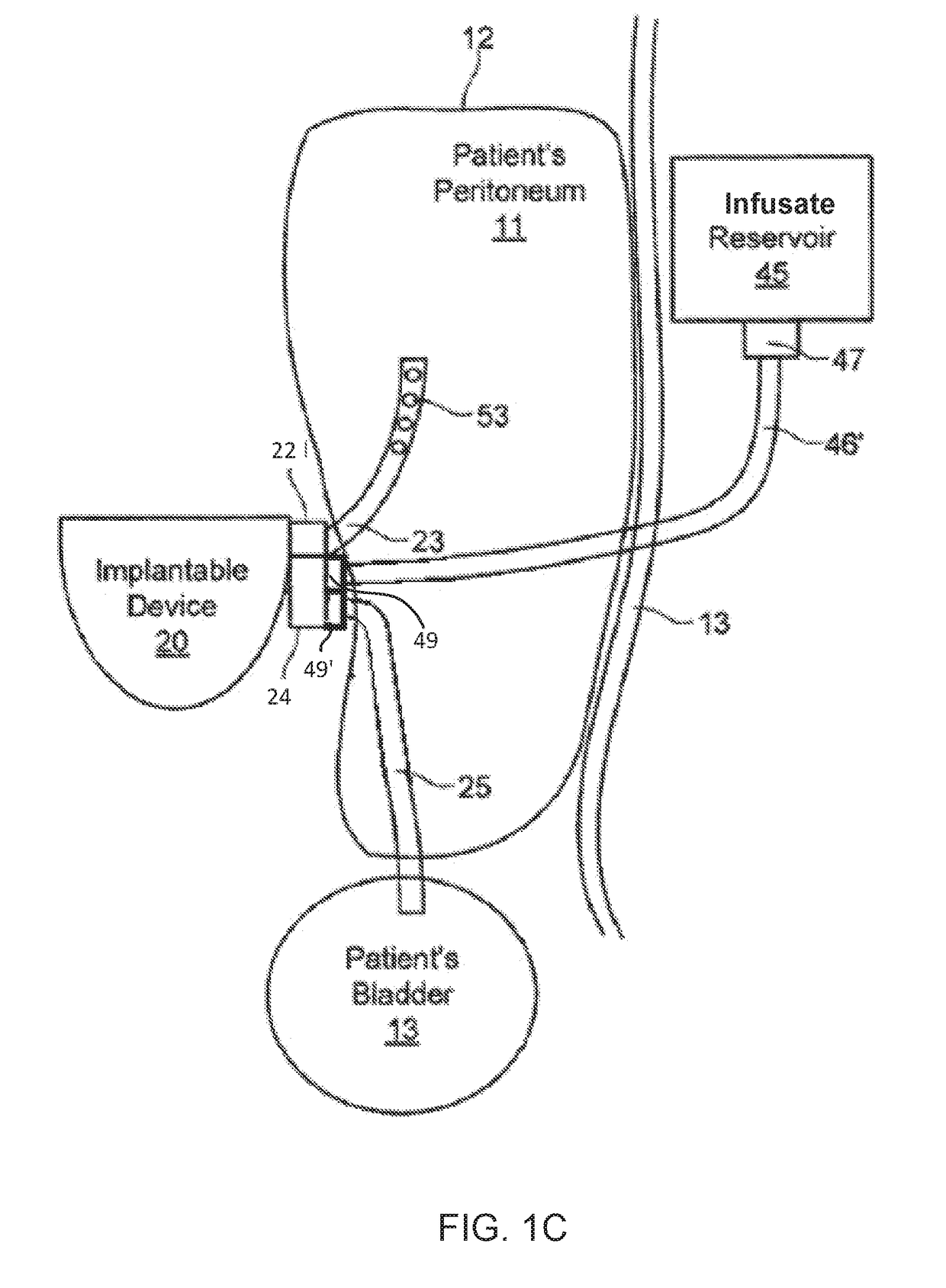 Direct sodium removal method, solution and apparatus to reduce fluid overload in heart failure patients