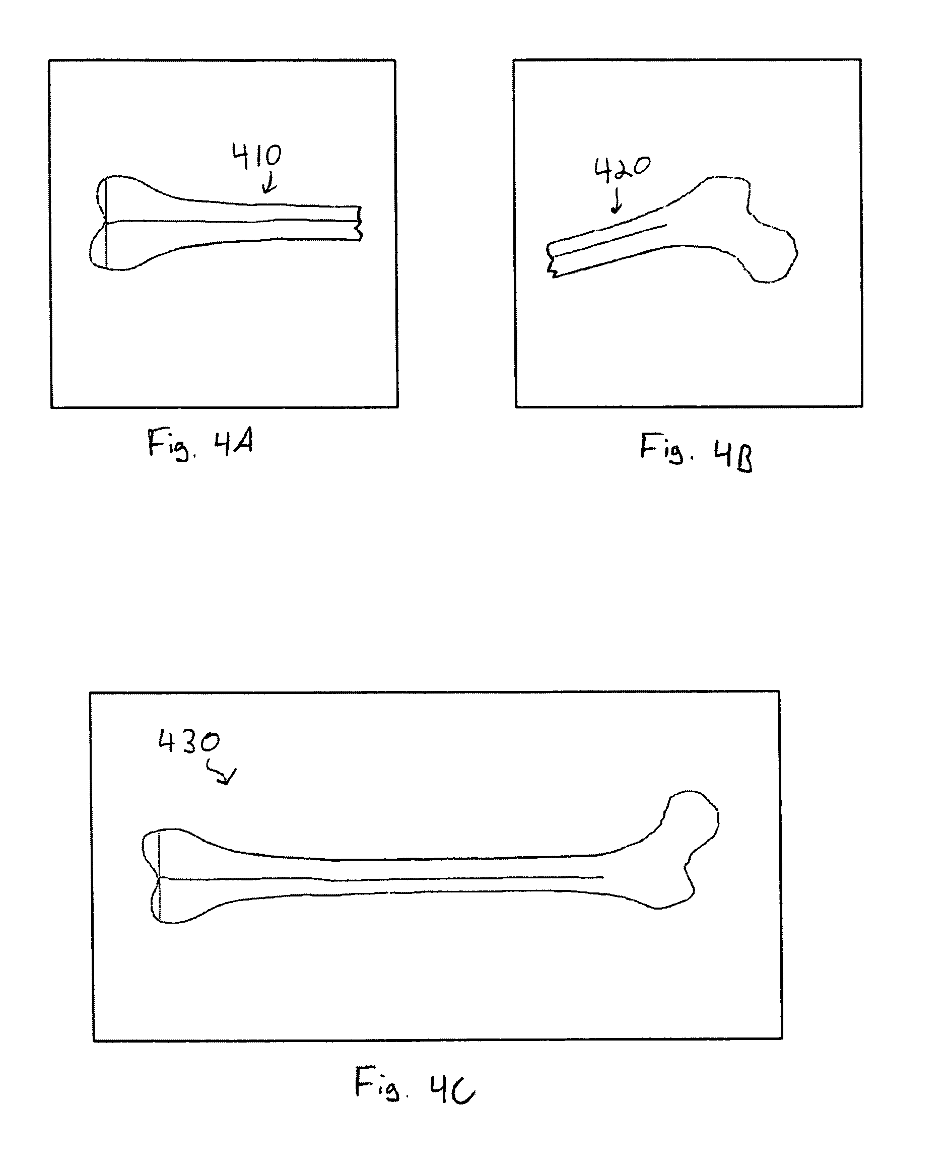 Method and system of computer assistance for the reduction of a fracture