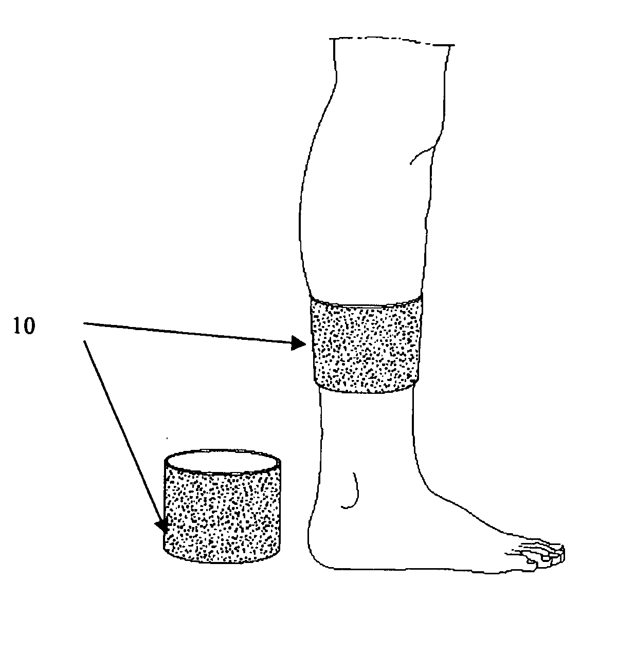 Device, method, and use for treatment of neuropathy involving nitric oxide