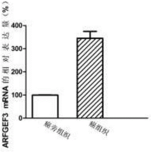 Application of gene used as biomarker in colon adenocarcinoma