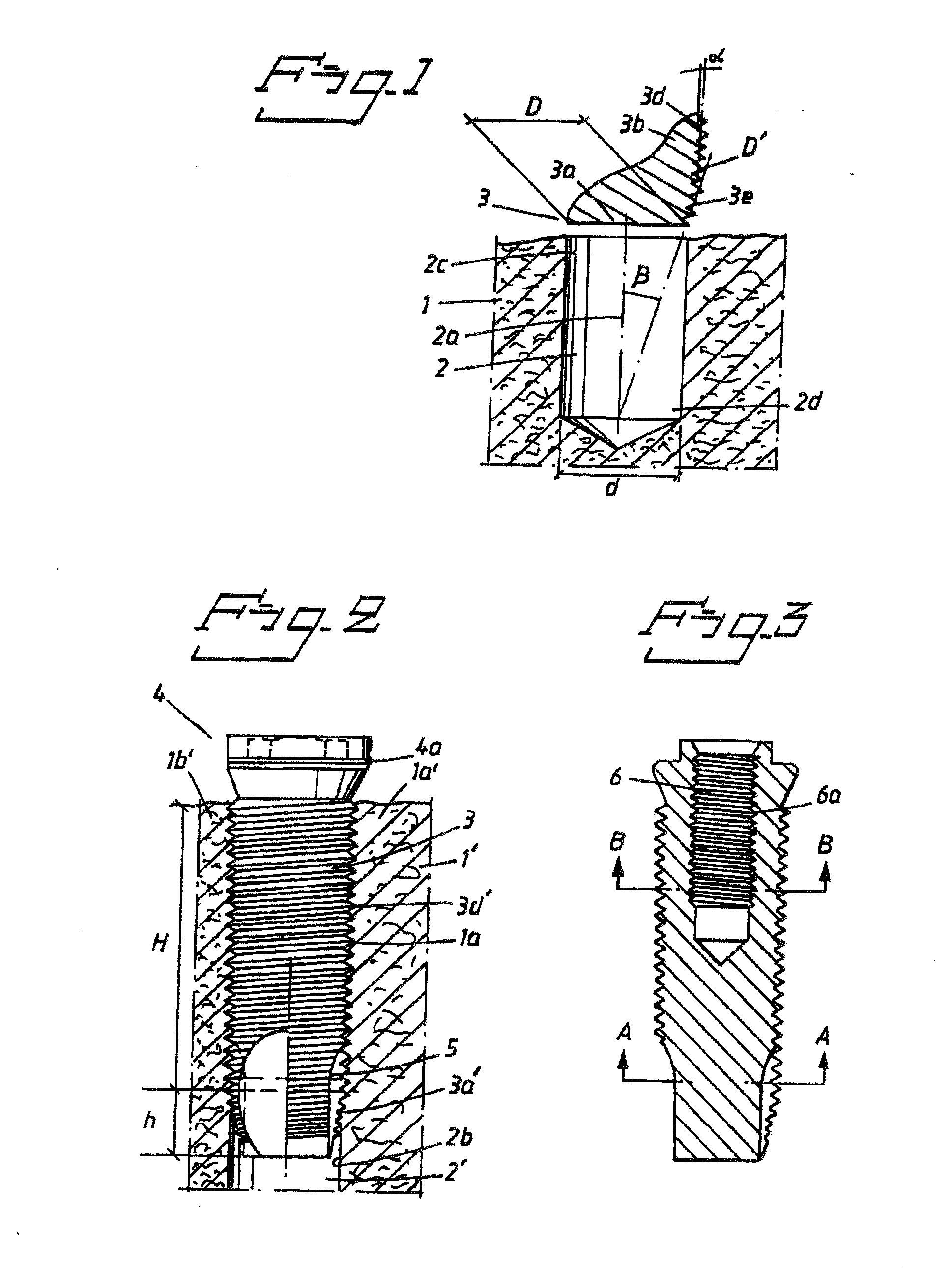 Arrangement for Obtaining Reliable Anchoring of a Threaded Implant in a Bone