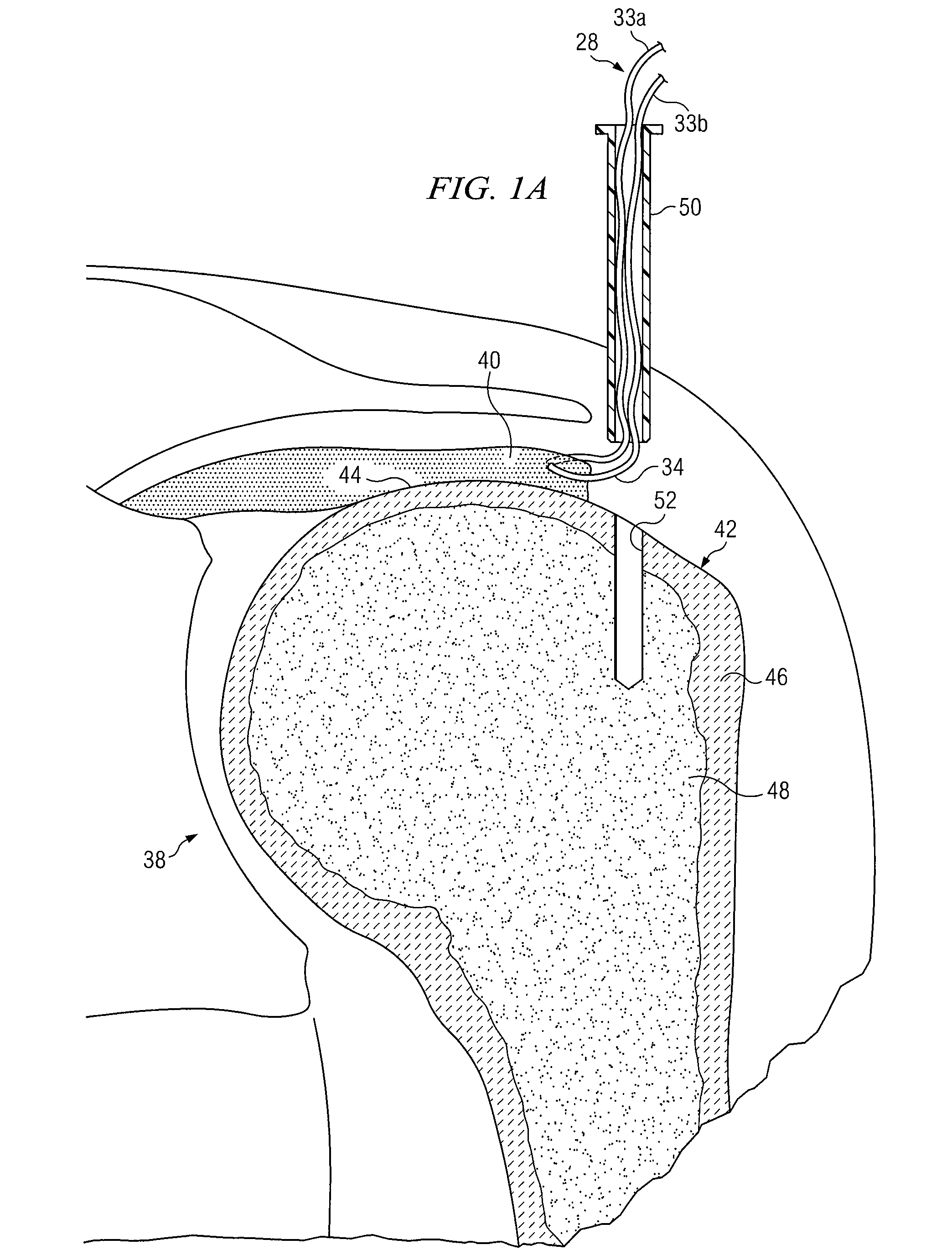 Knotless suture anchor having discrete polymer components and related methods