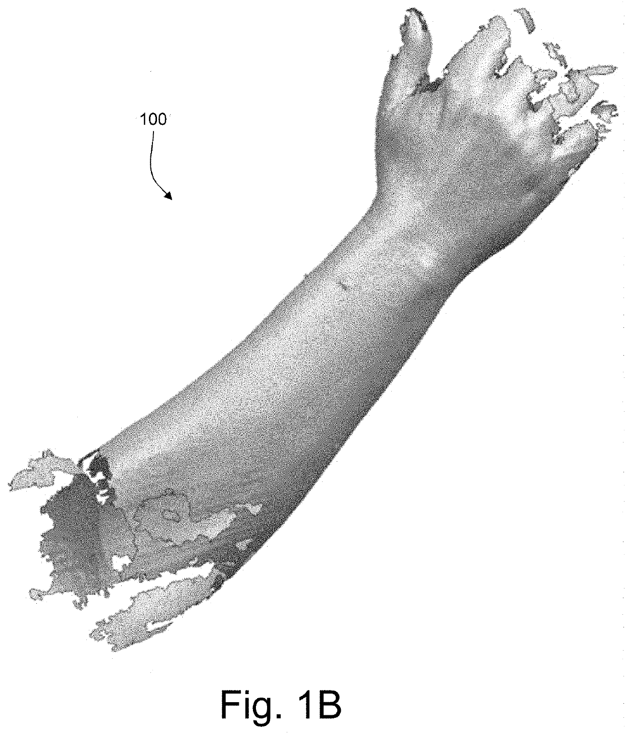 Production of a custom medical splint or brace for immobilization of a selected region of a patient's body part