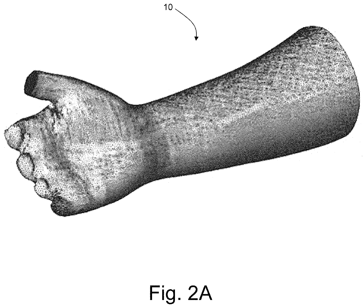 Production of a custom medical splint or brace for immobilization of a selected region of a patient's body part