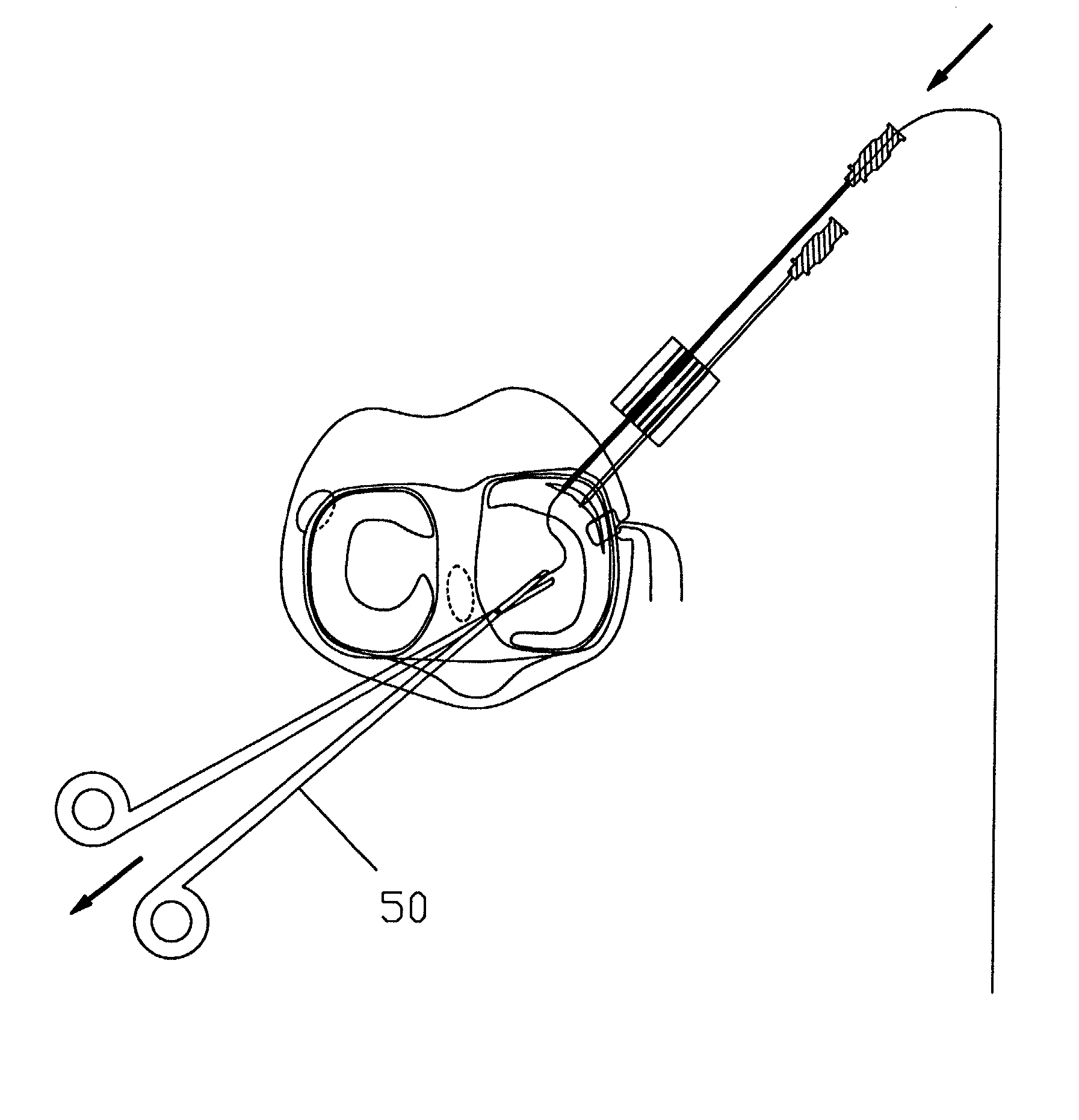 Surgical repair kit and its method of use