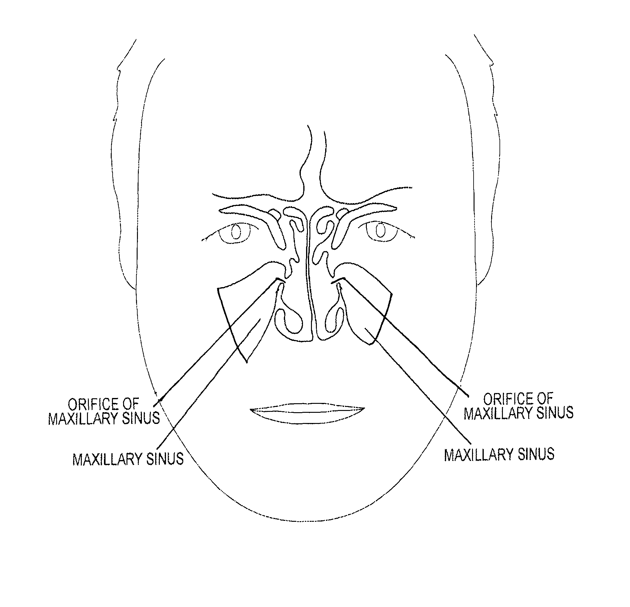 Device and method for delivering therapeutic substances to the maxillary sinus of a patient