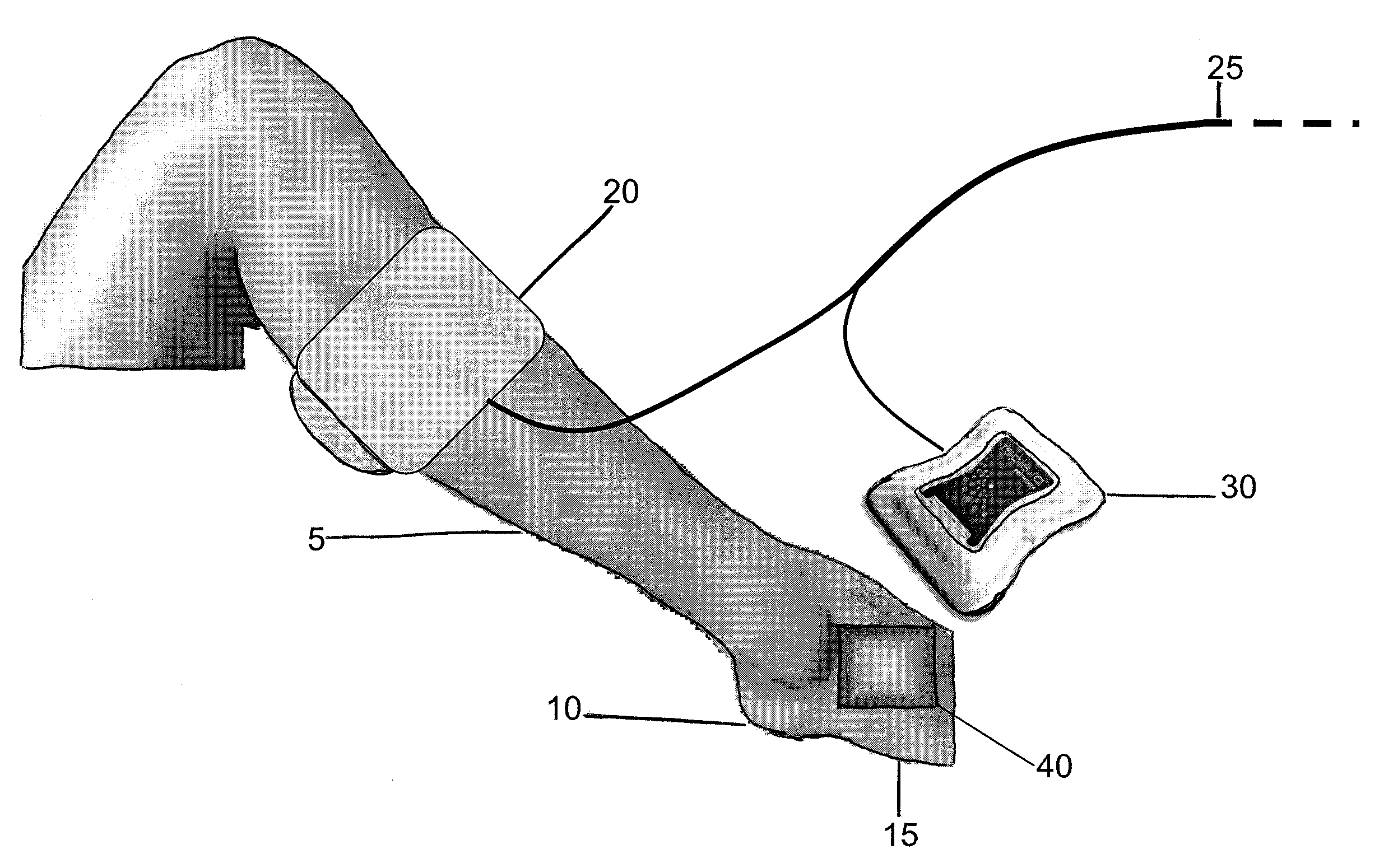 Method of treating a severe diabetic ulcer