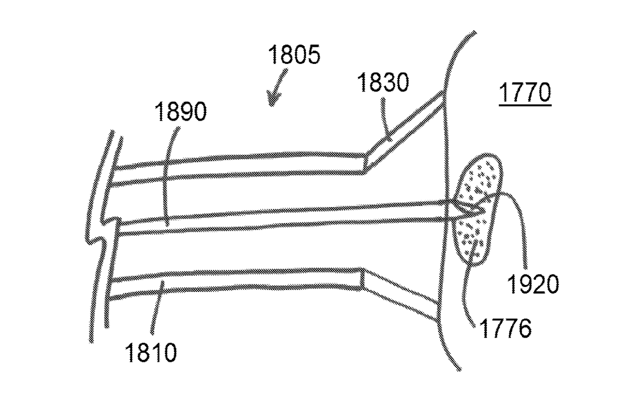 Materials and methods of using the same to improve structural integrity of a wall of a mammalian luminal organ