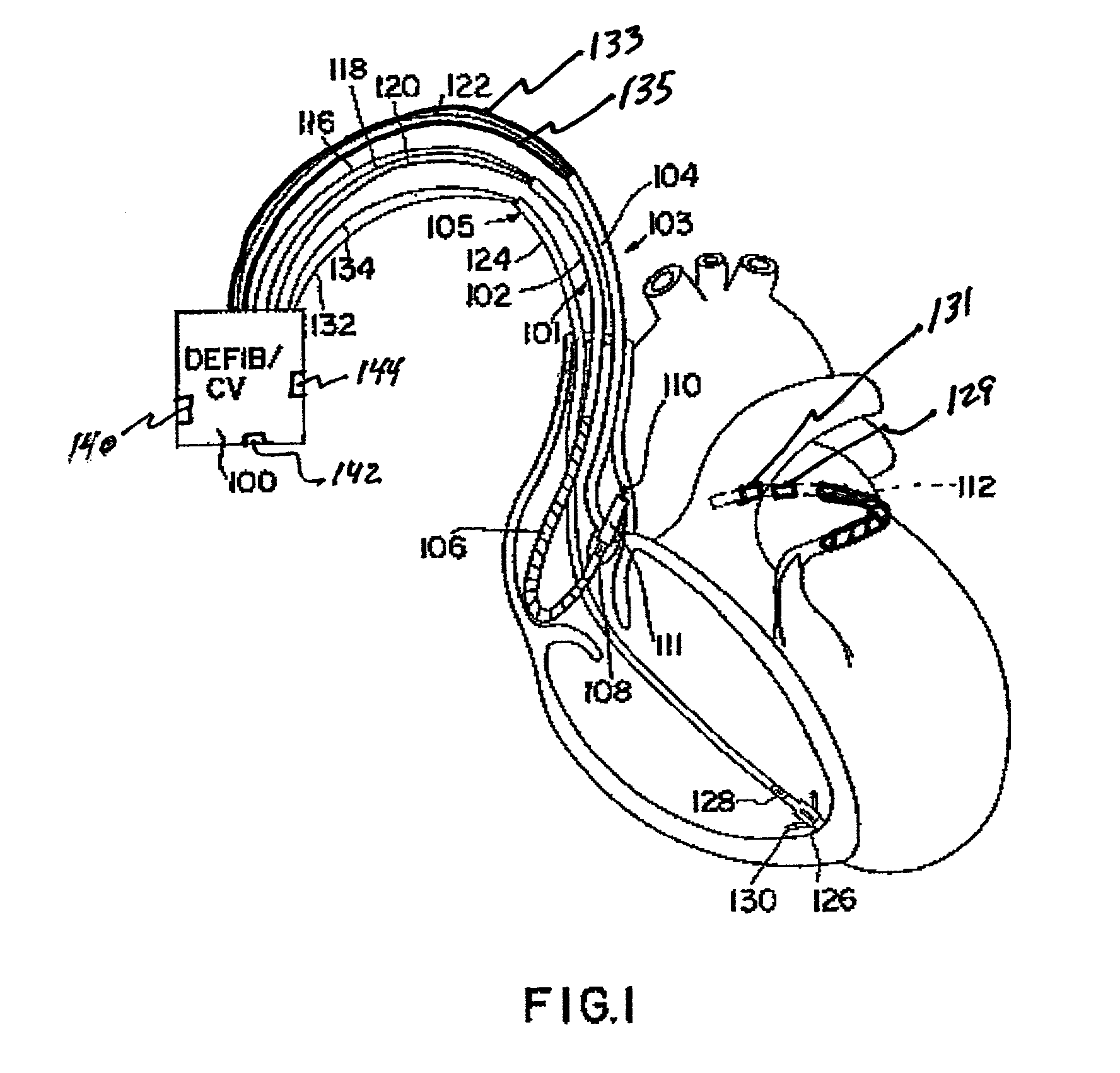 Method and apparatus for affecting atrial defibrillation with bi-atrial pacing