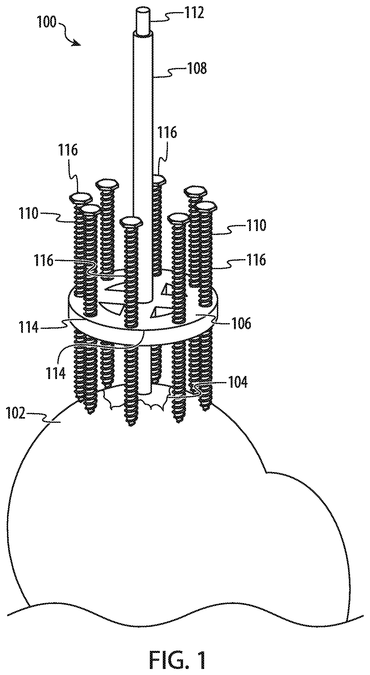 Transplantation Methods and Devices for Bone Surface Contouring