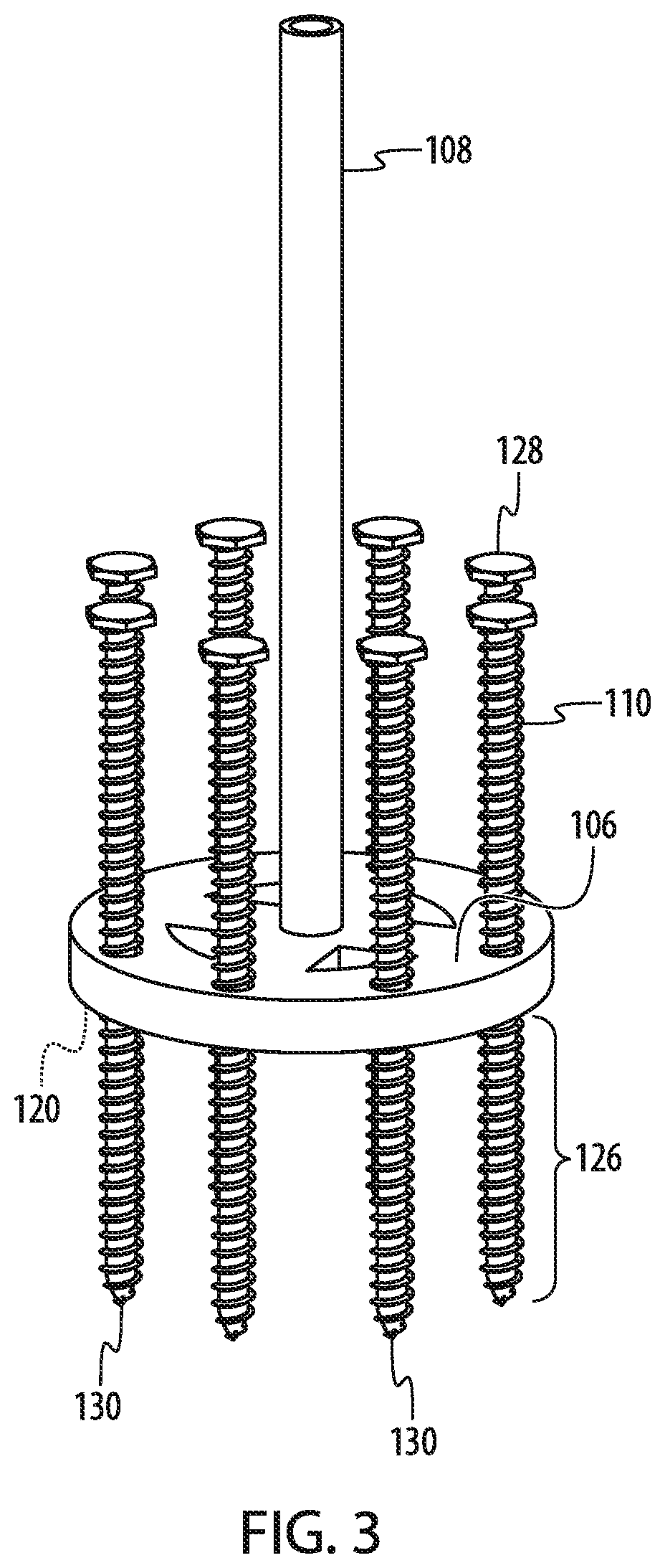 Transplantation Methods and Devices for Bone Surface Contouring