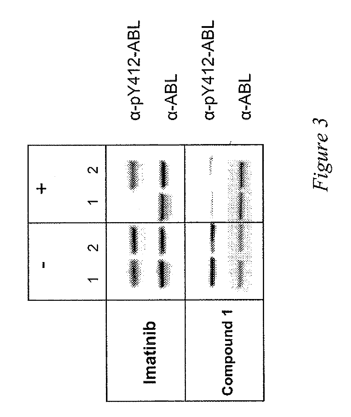 Use of a kinase inhibitor for the treatment of particular resistant tumors
