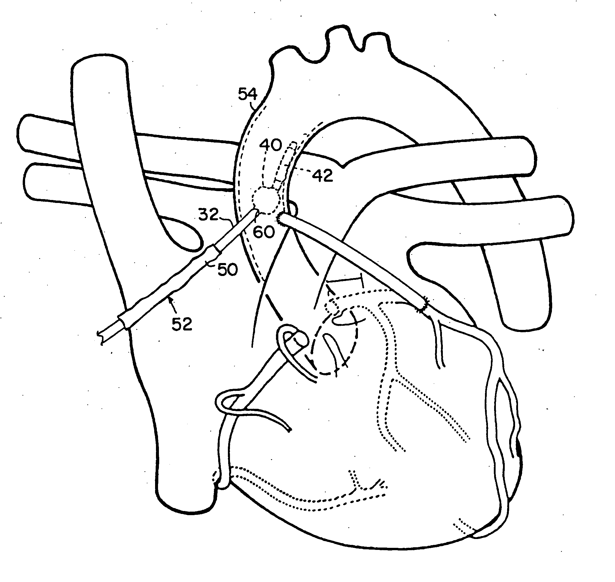 Intravascular balloon occlusion device and method for using the same