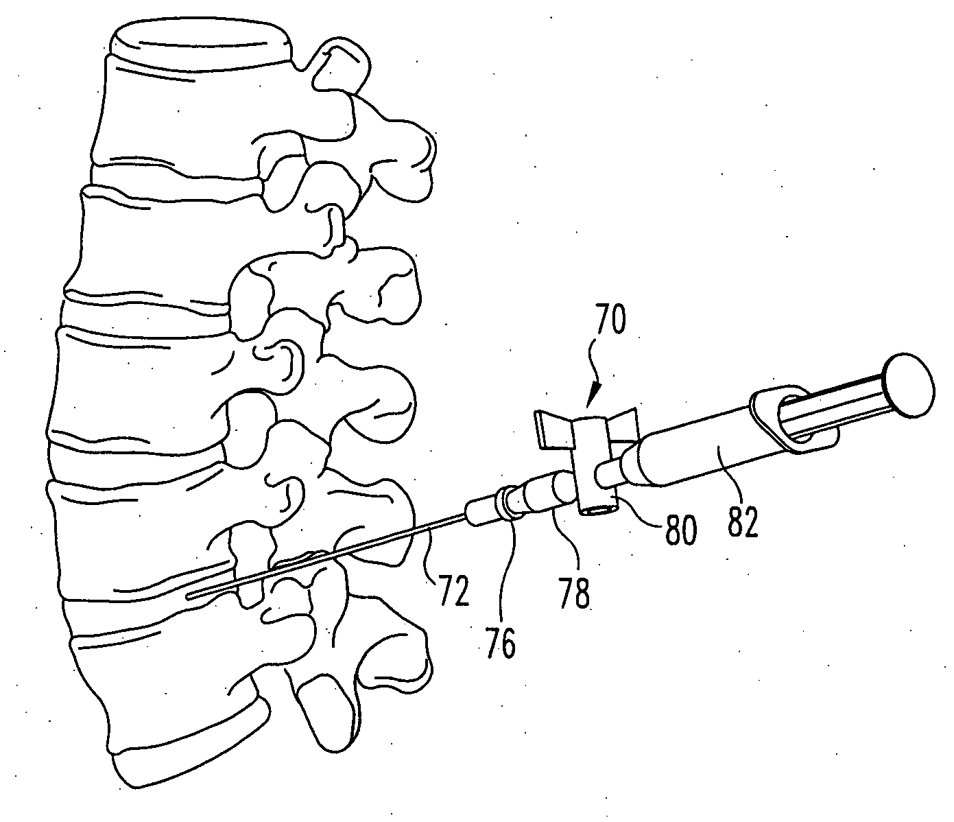 Percutaneous methods for injecting a curable biomaterial into an intervertebral space