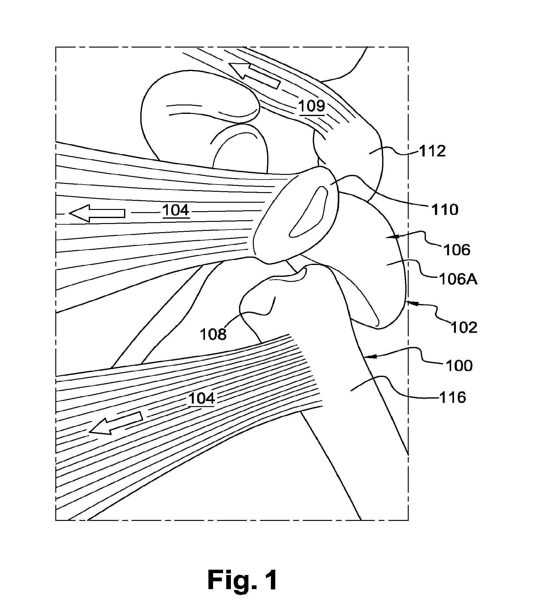 Surgical technique and apparatus for proximal humeral fracture repair