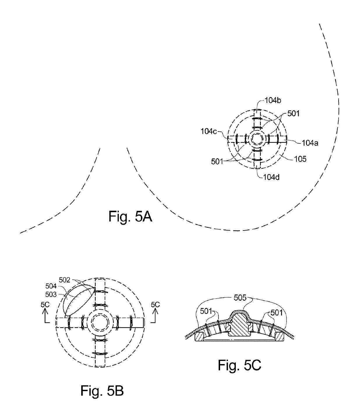 Mammary papilla implant and surgical method