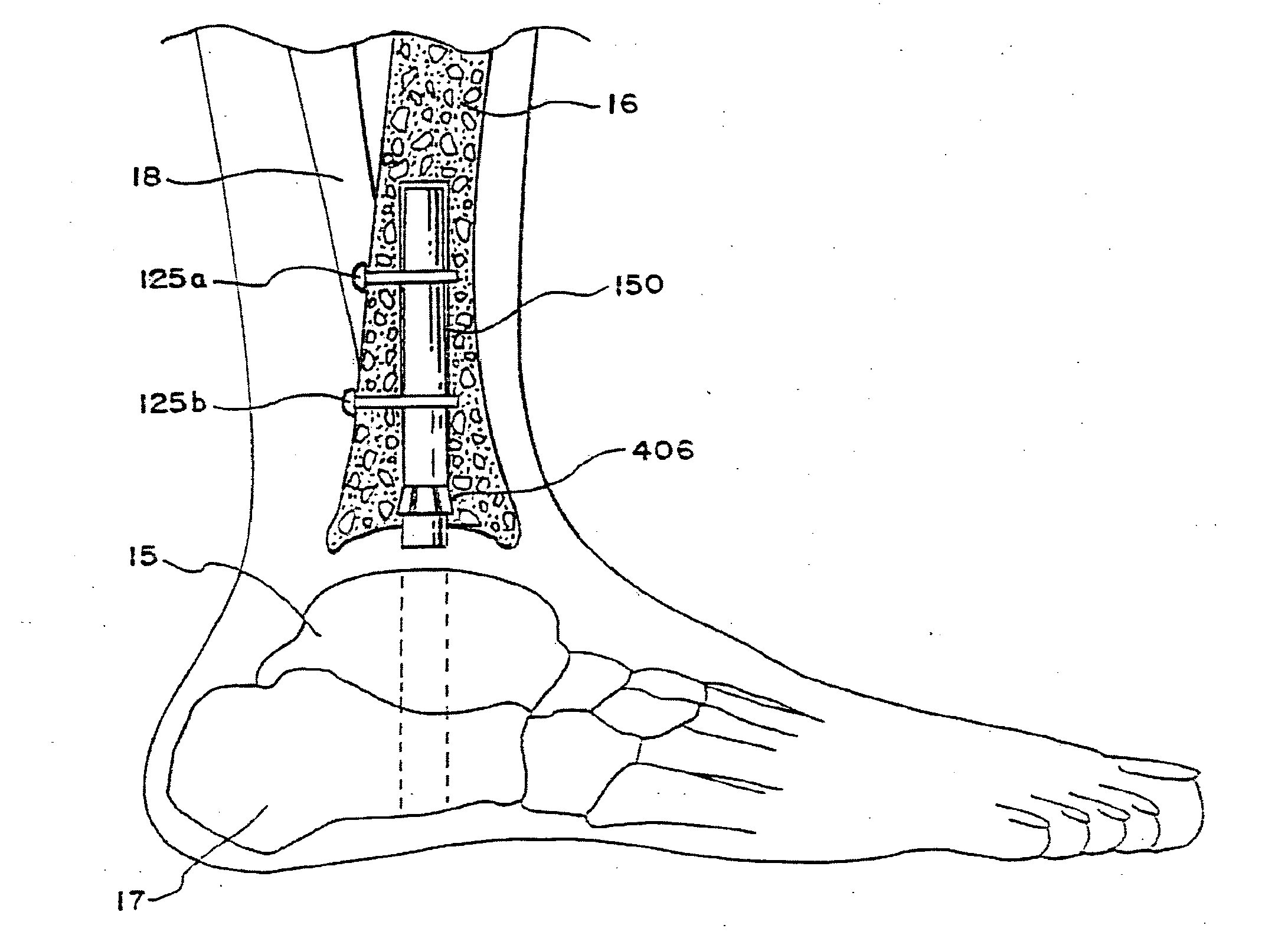 Systems and Methods for Installing Ankle Replacement Prostheses